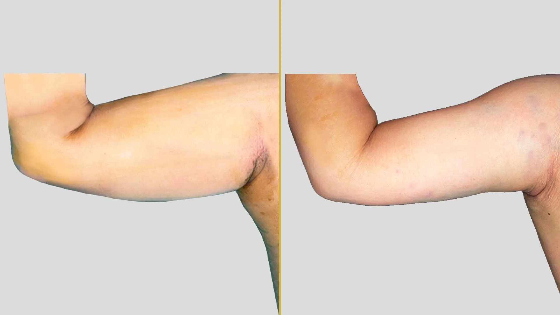 Arm Contouring (Brachioplasty) before and after result - The Hair and Shape Clinic, Mumbai