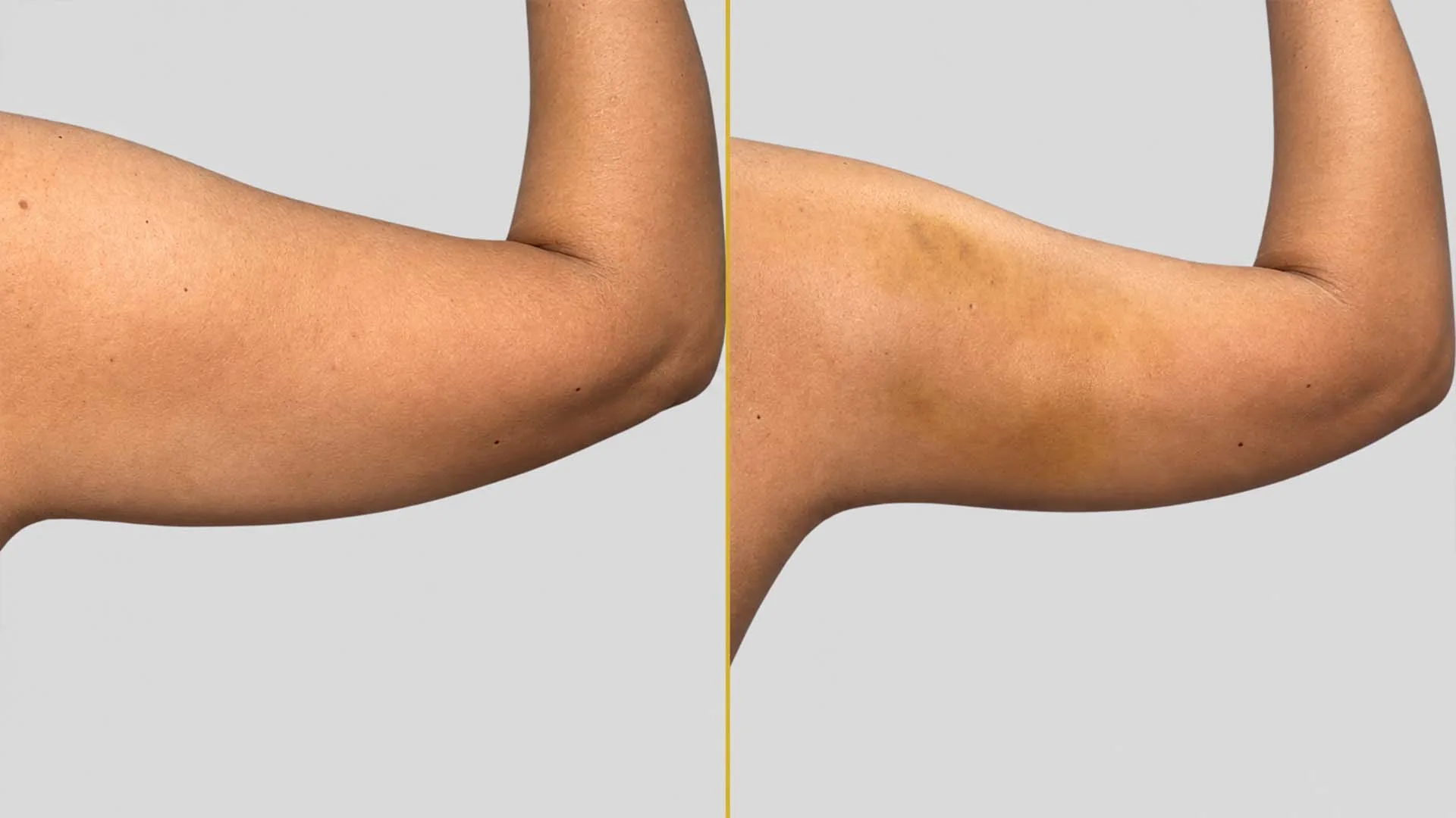Arm Contouring (Brachioplasty) before and after result - The Hair and Shape Clinic, Mumbai
