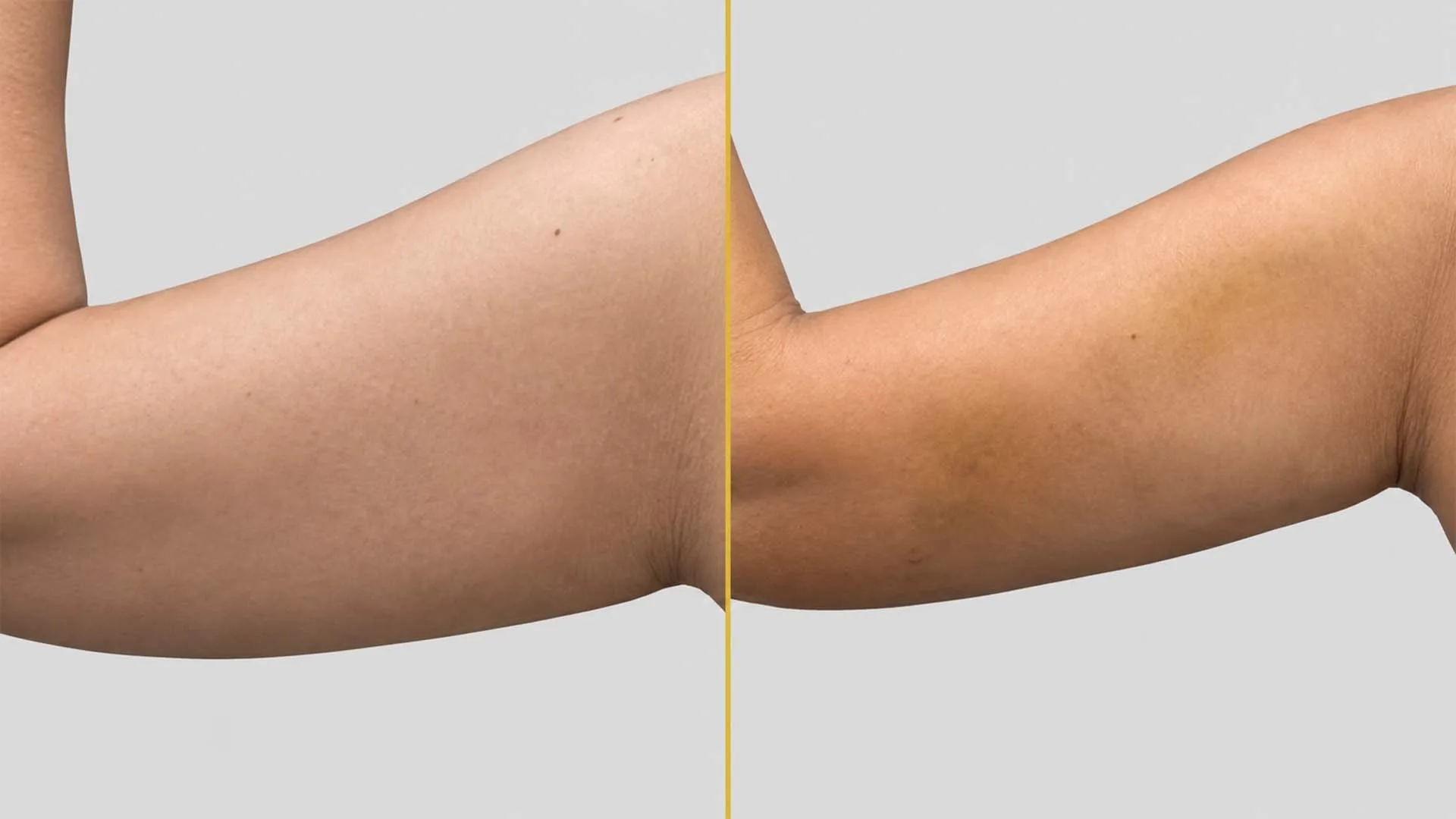 Arm Contouring (Brachioplasty) before and after result - The Hair and Shape Clinic, Mumbai