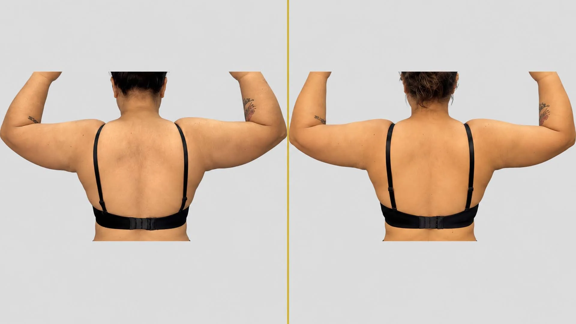 Arm Contouring (Brachioplasty) before and after result - The Hair and Shape Clinic, Mumbai