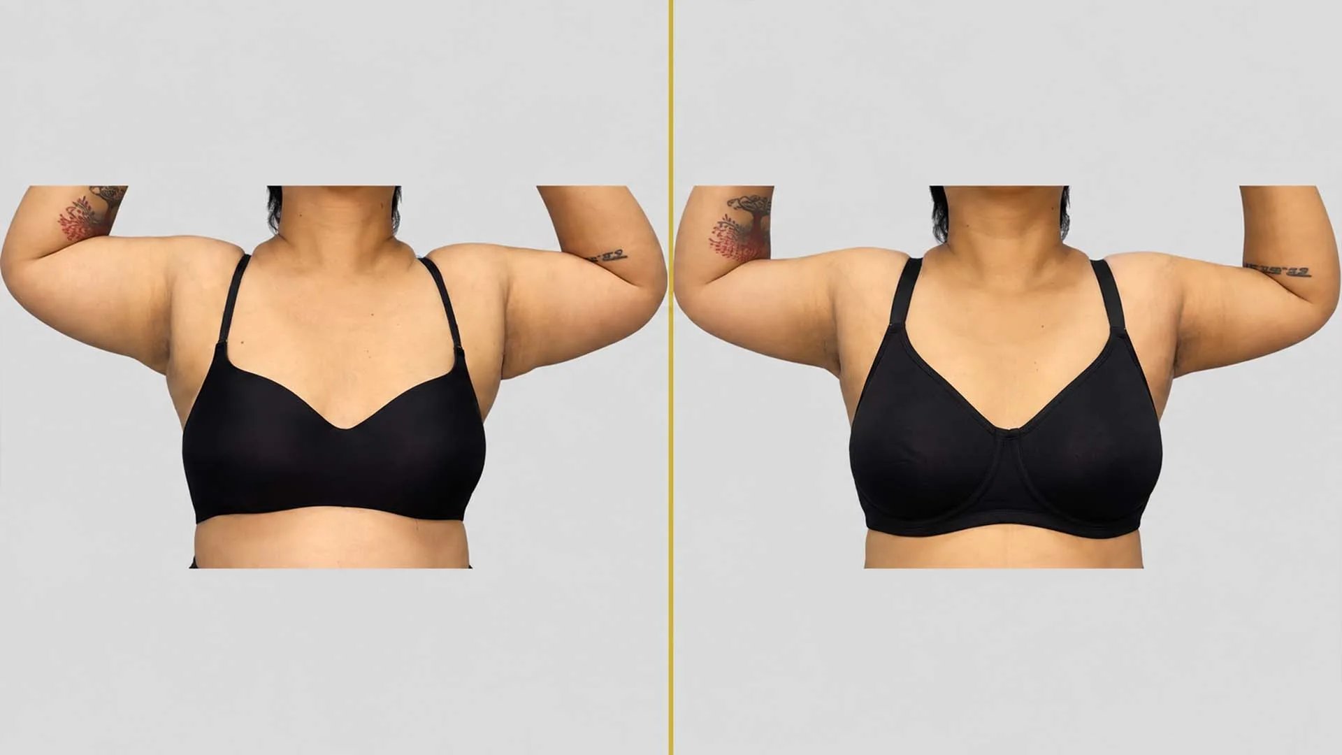 Arm Contouring (Brachioplasty) before and after result - The Hair and Shape Clinic, Mumbai