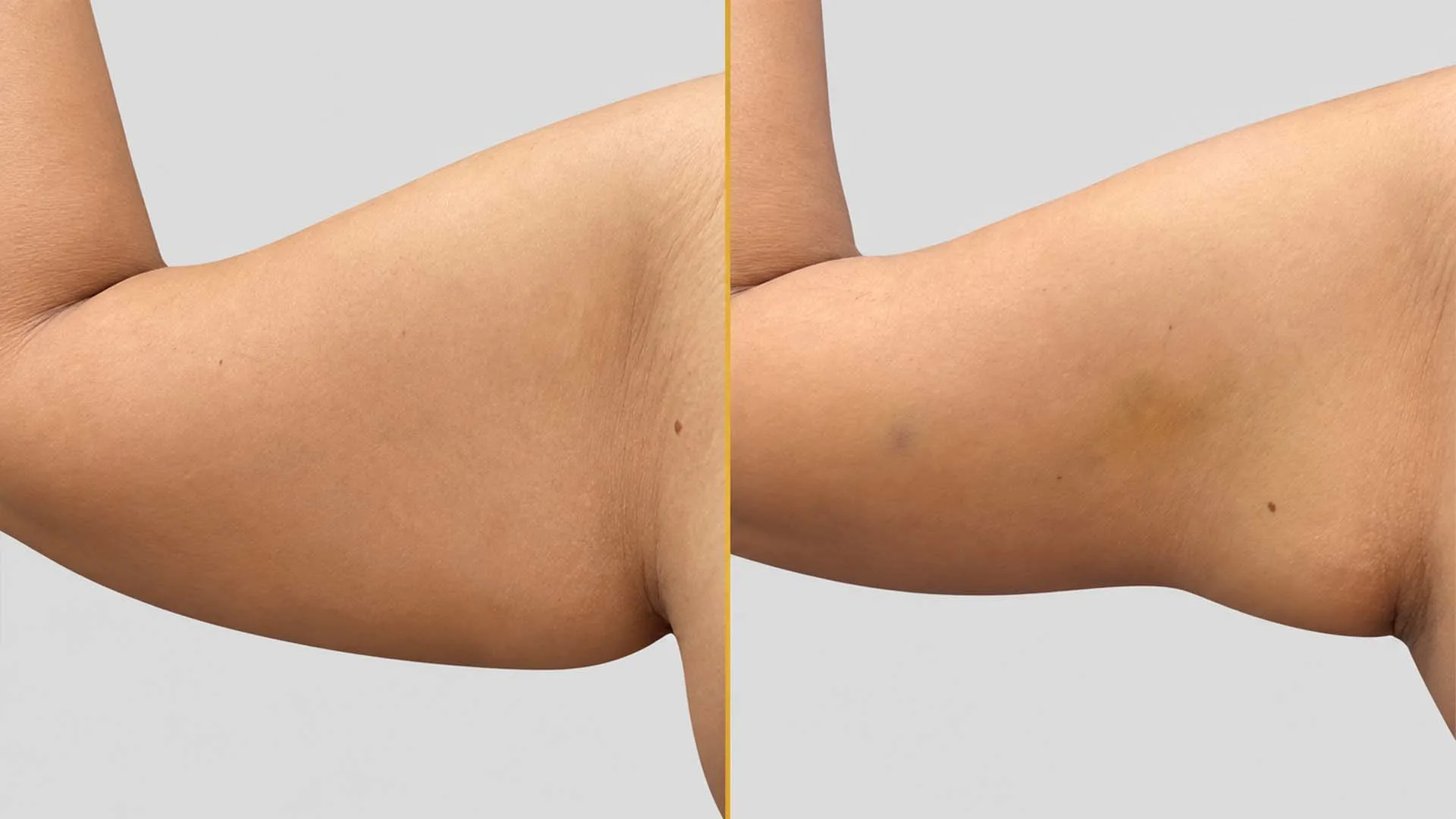 Arm Contouring (Brachioplasty) before and after result - The Hair and Shape Clinic, Mumbai