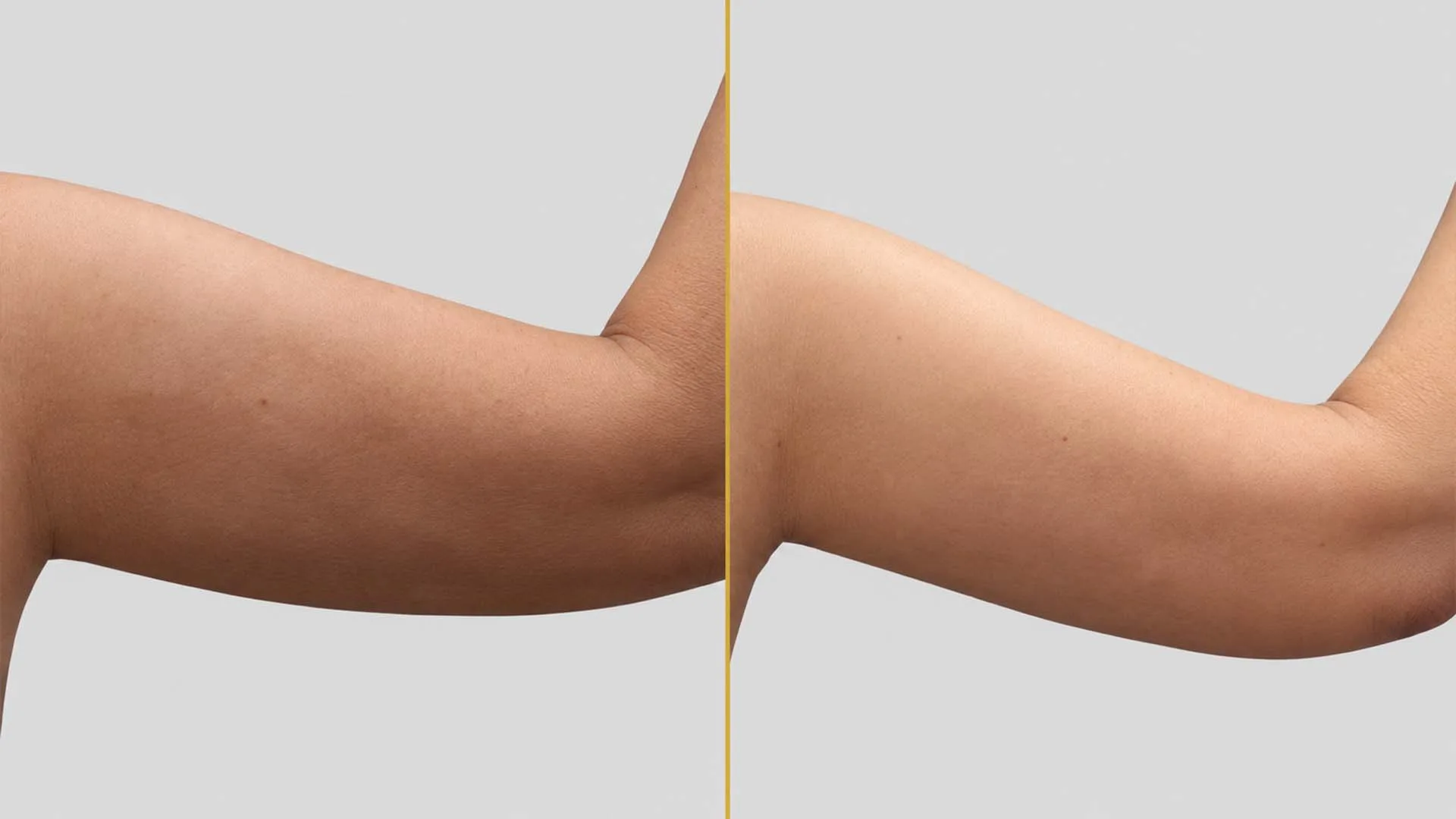 Arm Contouring (Brachioplasty) before and after result - The Hair and Shape Clinic, Mumbai