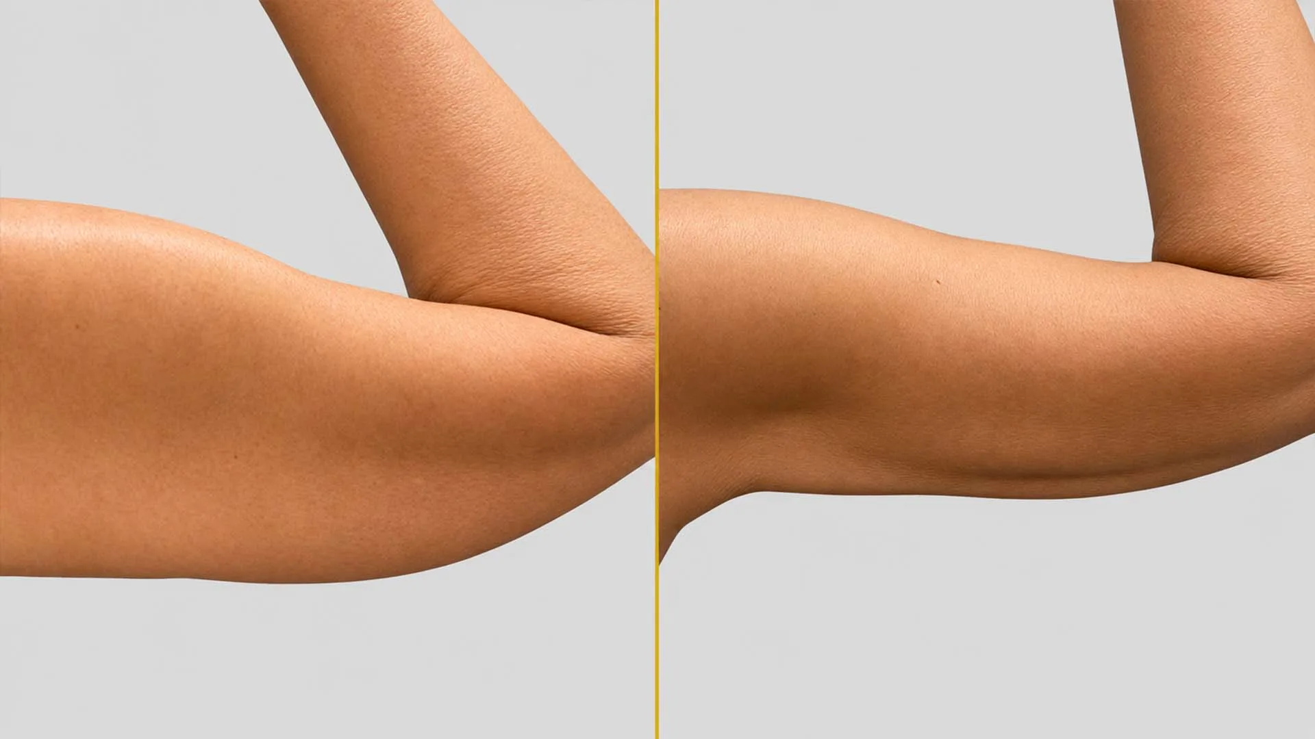 Arm Contouring (Brachioplasty) before and after result - The Hair and Shape Clinic, Mumbai