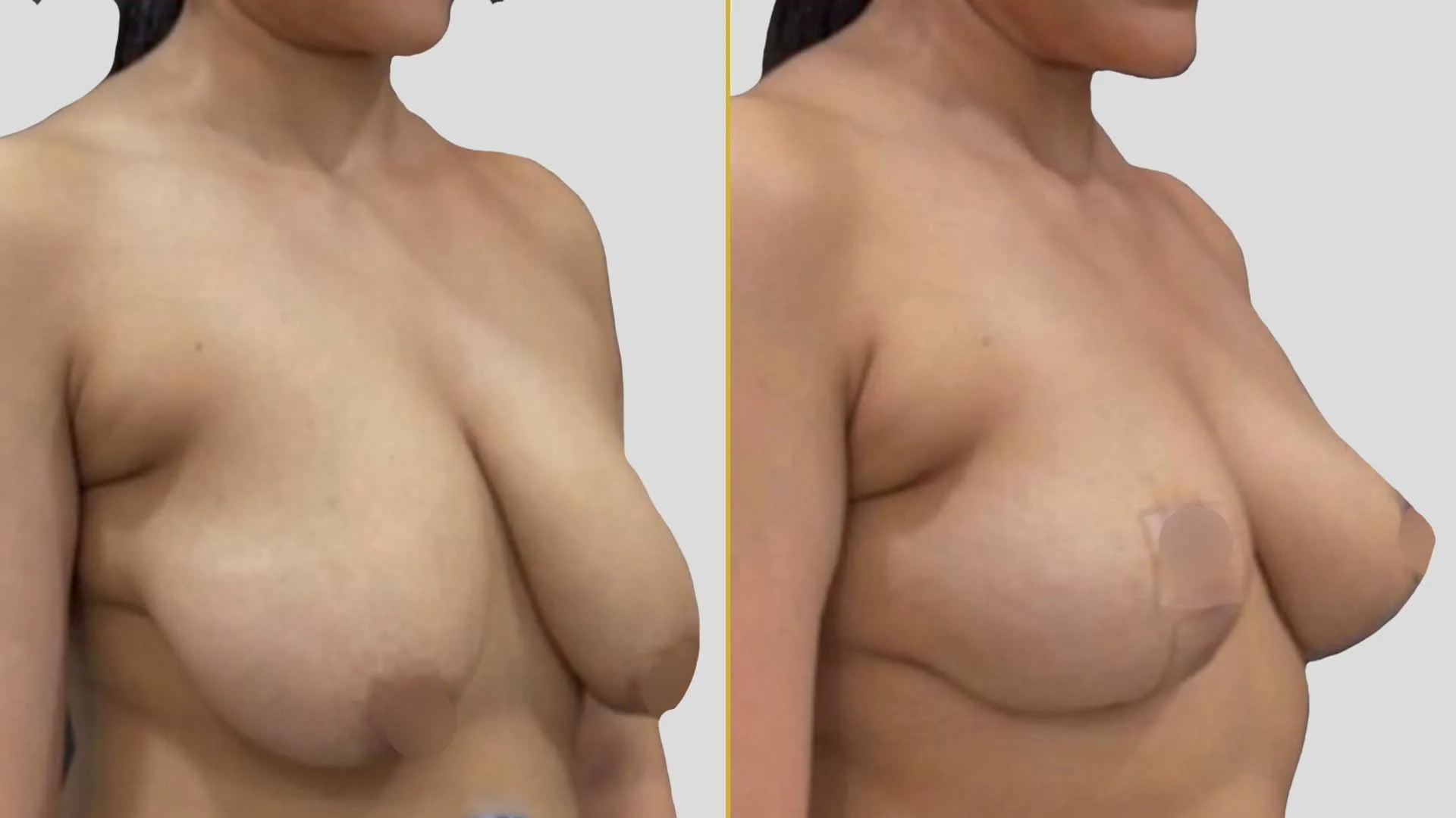 Breast Lift (Mastopexy) before and after result - The Hair and Shape Clinic, Mumbai
