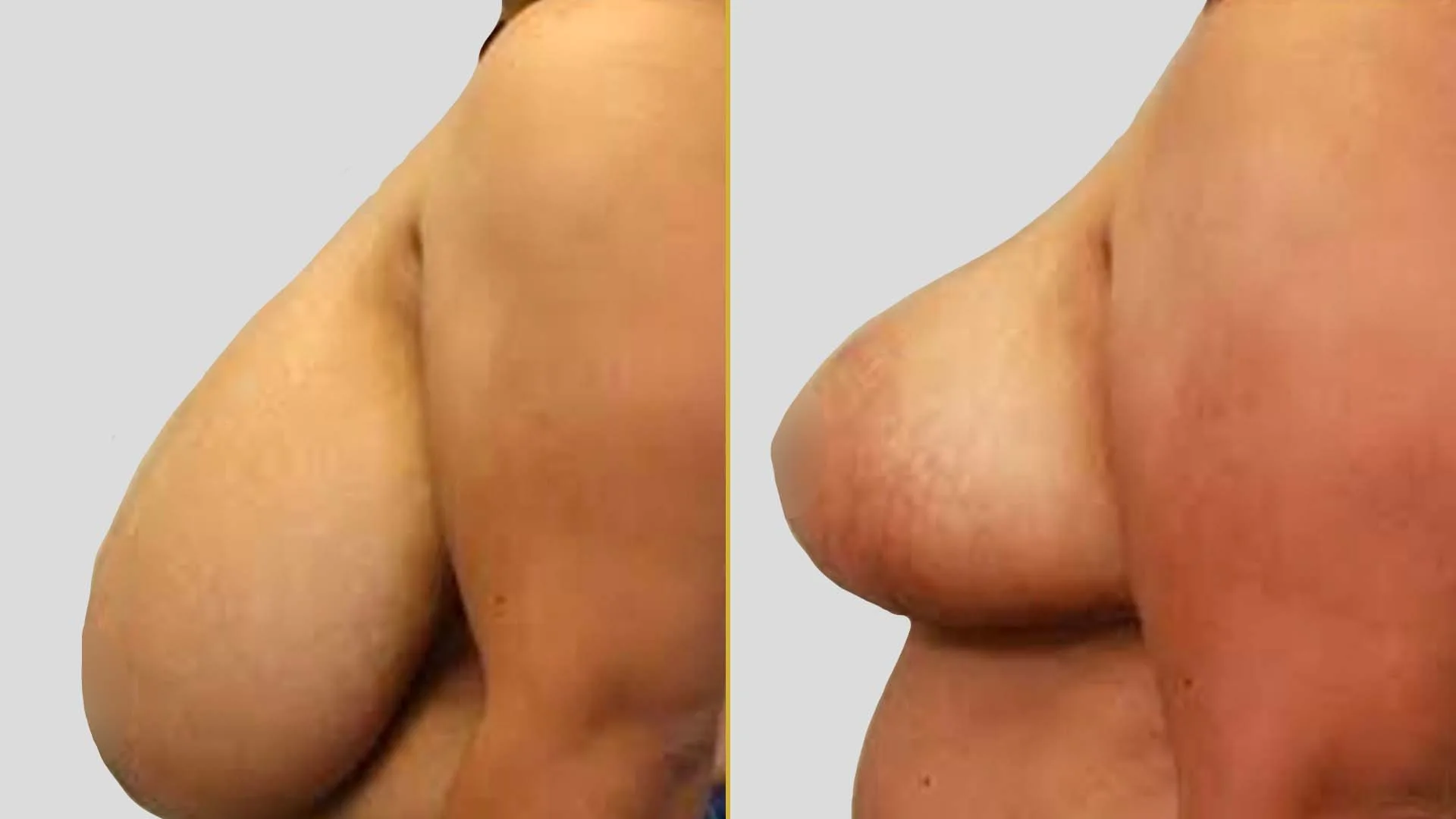 Breast Lift (Mastopexy) before and after result - The Hair and Shape Clinic, Mumbai