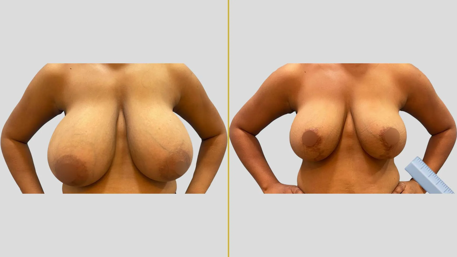 Breast Lift (Mastopexy) before and after result - The Hair and Shape Clinic, Mumbai