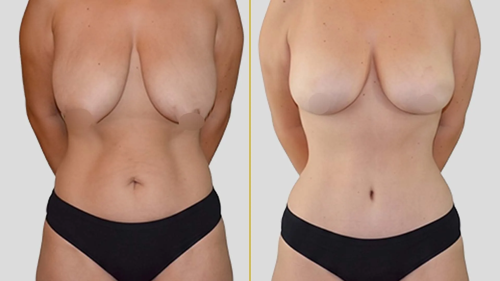 Breast Lift (Mastopexy) before and after result - The Hair and Shape Clinic, Mumbai