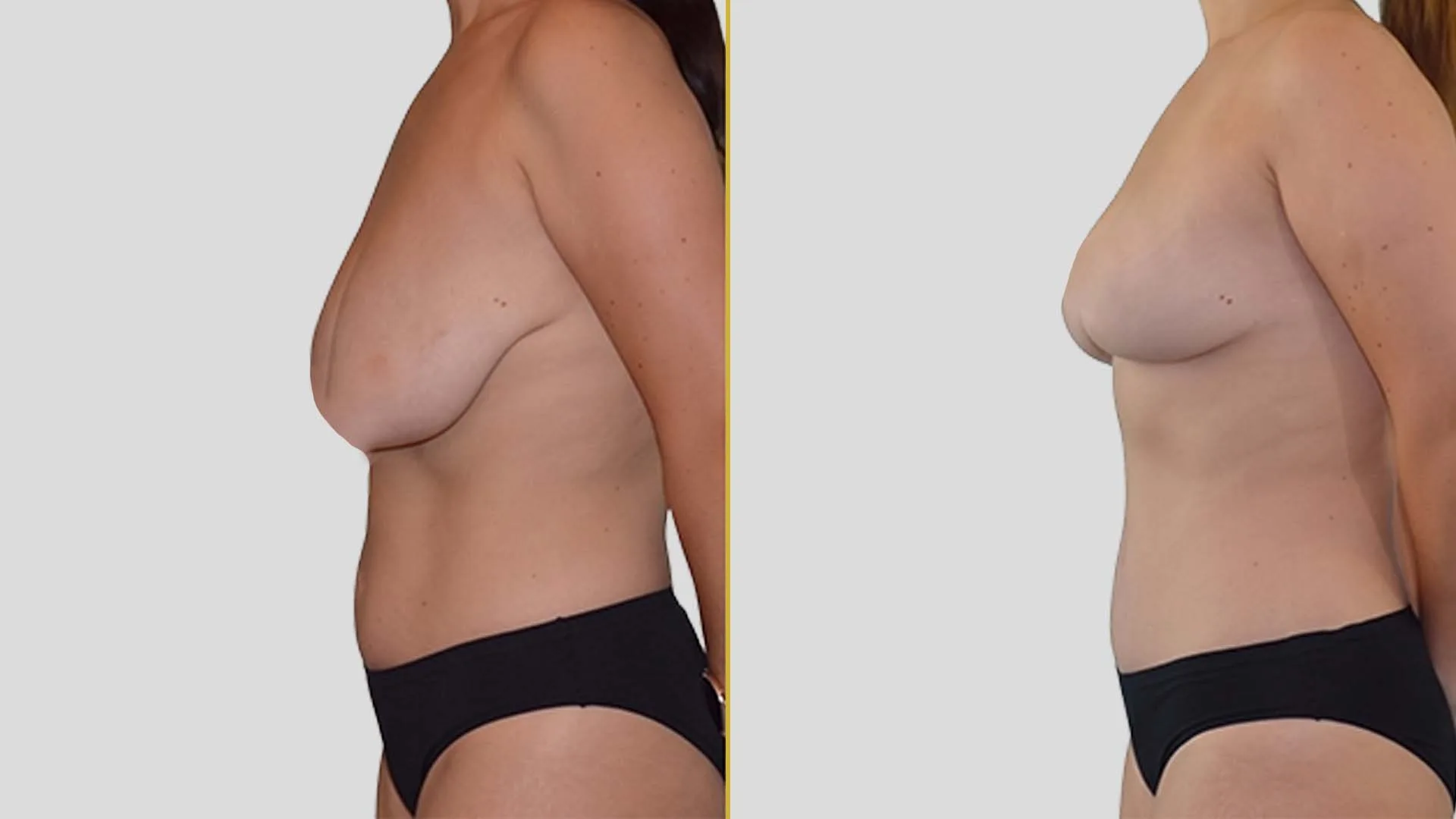 Breast Lift (Mastopexy) before and after result - The Hair and Shape Clinic, Mumbai