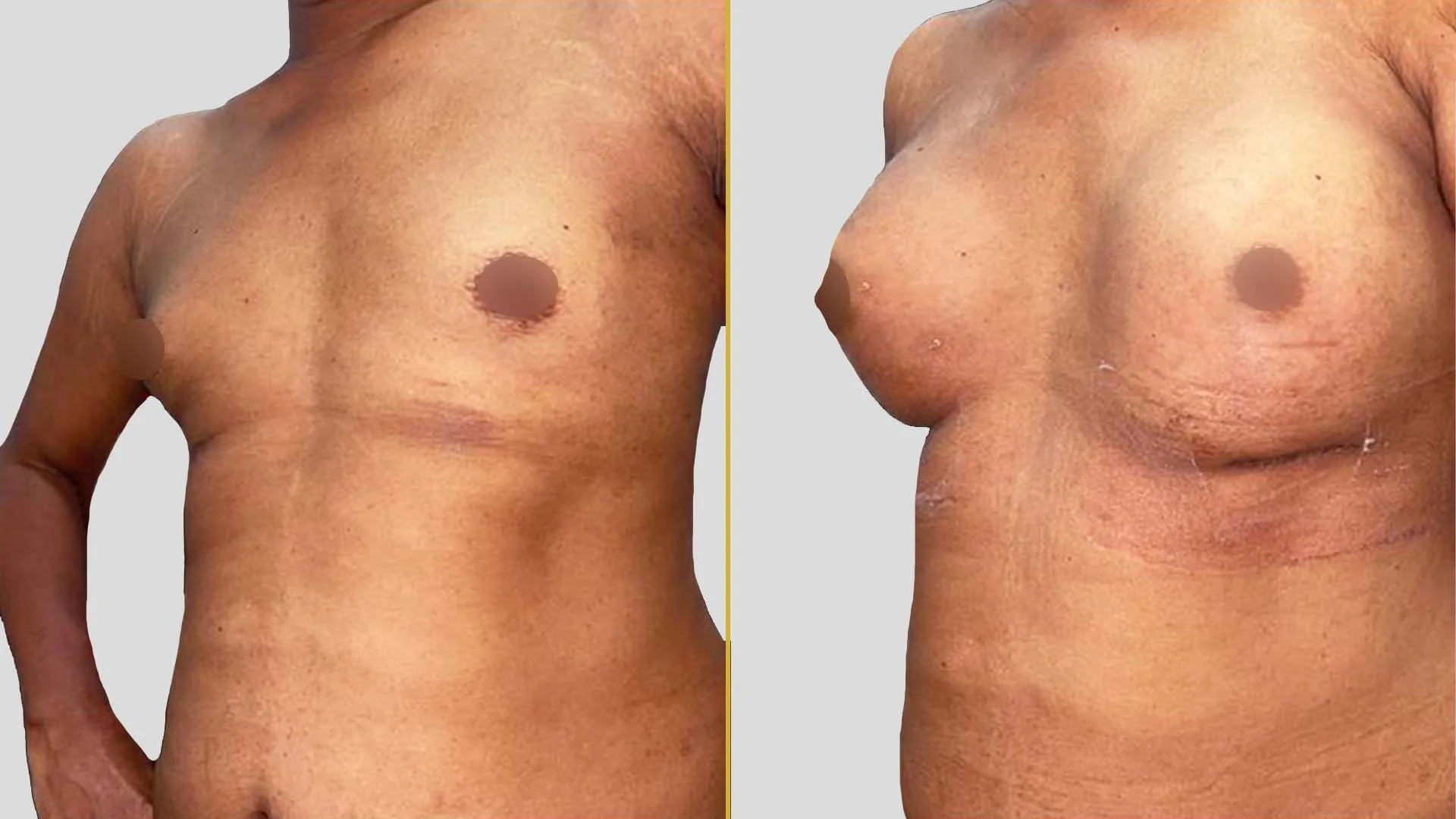 Breast Lift (Mastopexy) before and after result - The Hair and Shape Clinic, Mumbai