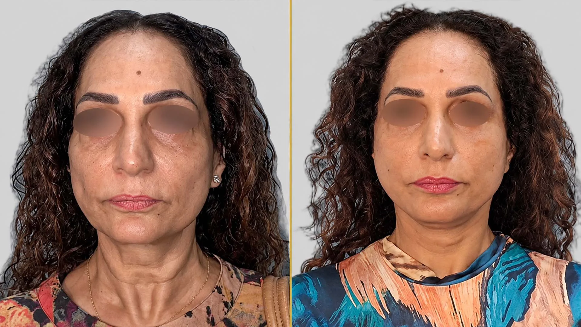 Face Lift before and after result - The Hair and Shape Clinic, Mumbai
