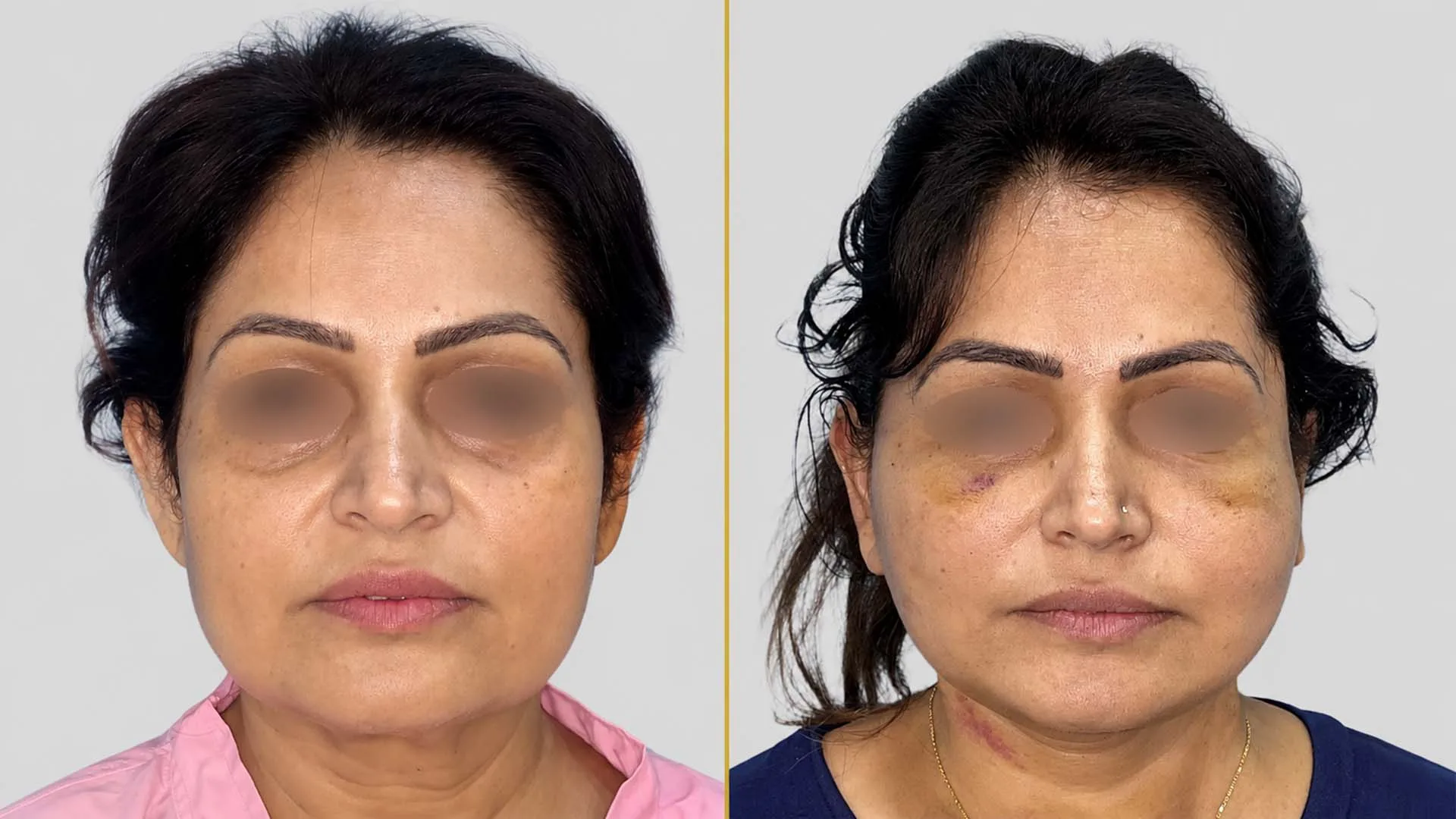 Face Lift before and after result - The Hair and Shape Clinic, Mumbai