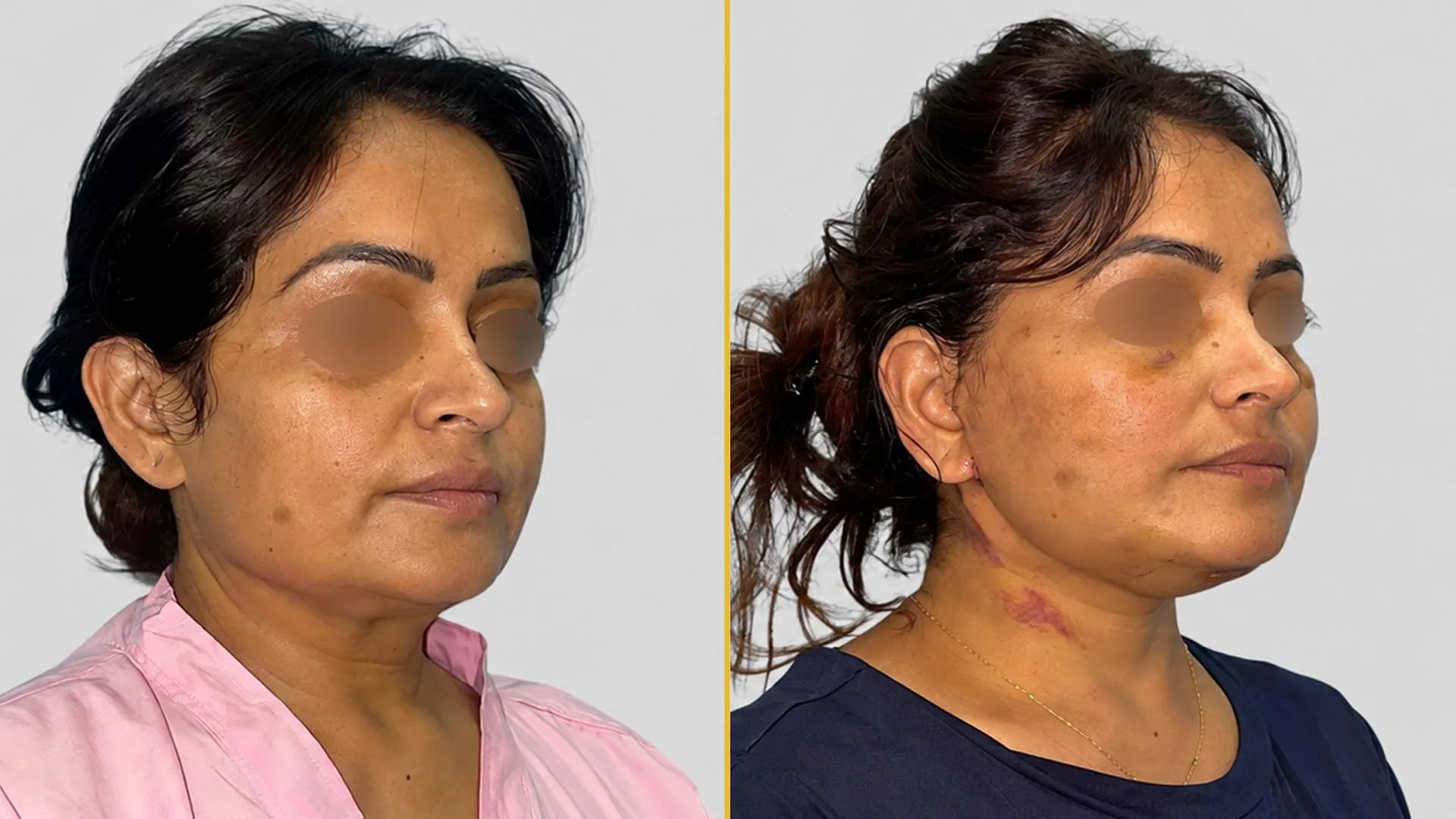 Face Lift before and after result - The Hair and Shape Clinic, Mumbai