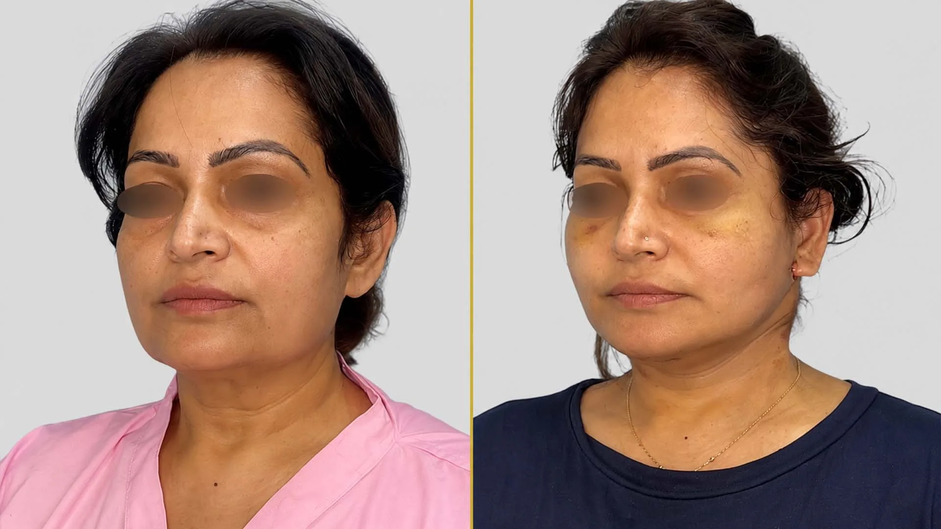 Face Lift before and after result - The Hair and Shape Clinic, Mumbai