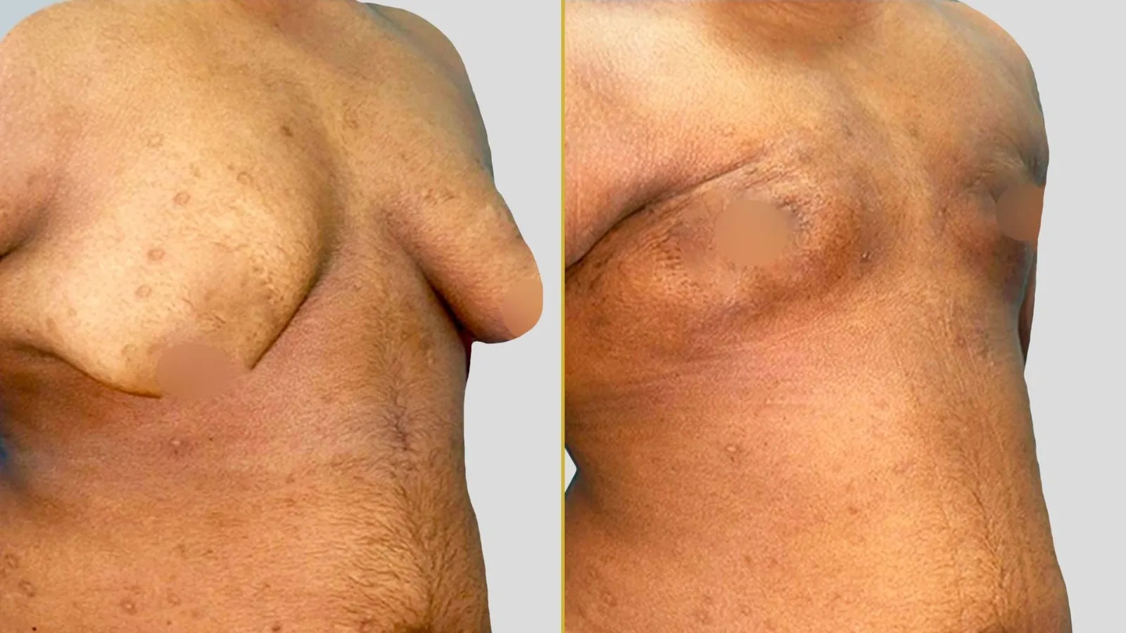 Gender Reassignment before and after result - The Hair and Shape Clinic, Mumbai