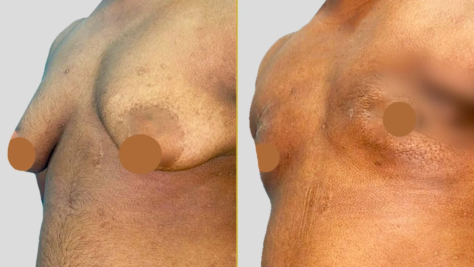 Gender Reassignment before and after result - The Hair and Shape Clinic, Mumbai