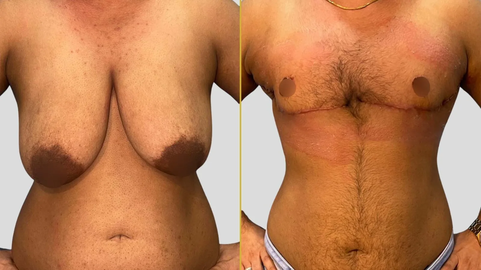 Gender Reassignment before and after result - The Hair and Shape Clinic, Mumbai