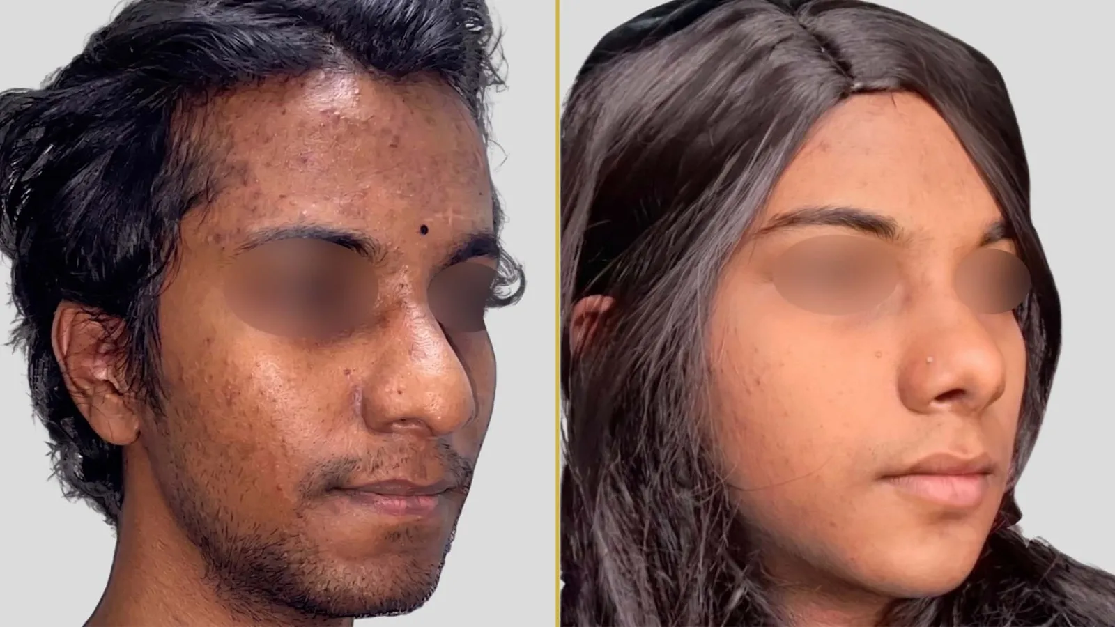 Gender Reassignment before and after result - The Hair and Shape Clinic, Mumbai
