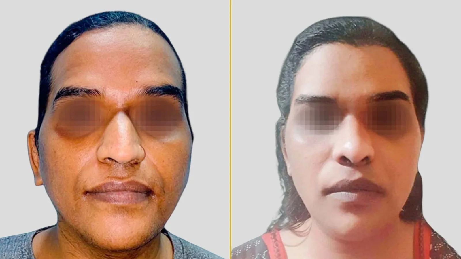 Gender Reassignment before and after result - The Hair and Shape Clinic, Mumbai