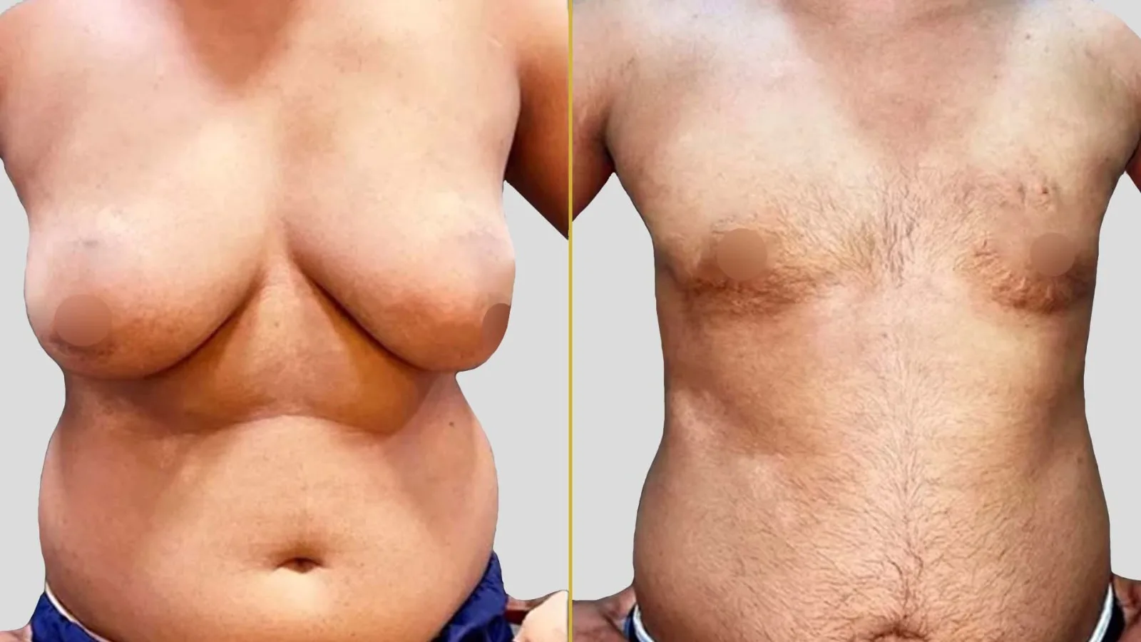 Gender Reassignment before and after result - The Hair and Shape Clinic, Mumbai
