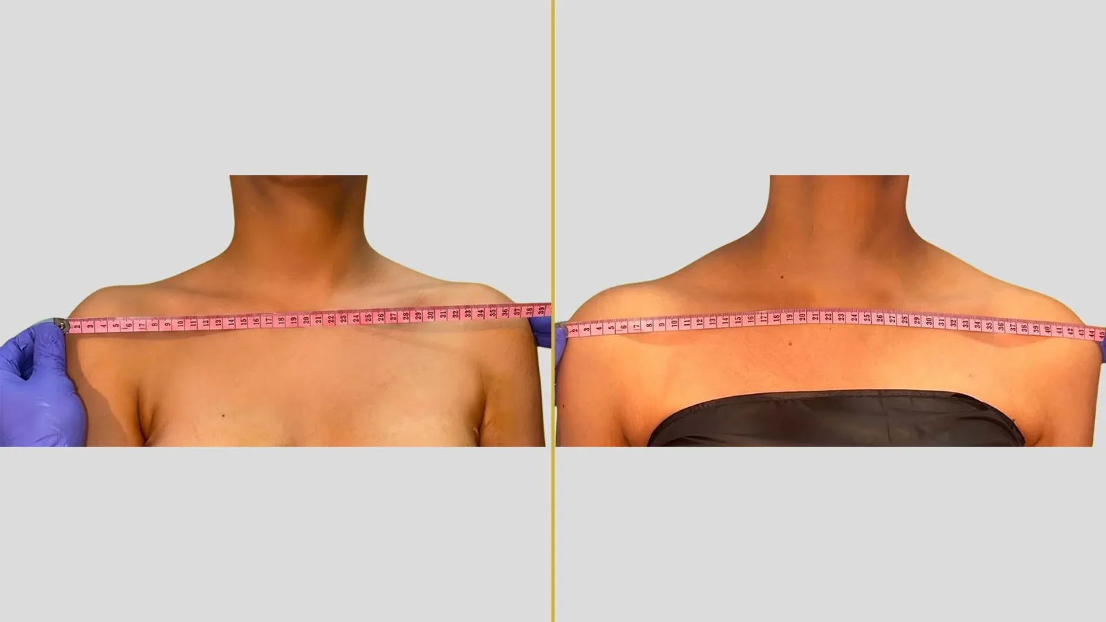 Gender Reassignment before and after result - The Hair and Shape Clinic, Mumbai