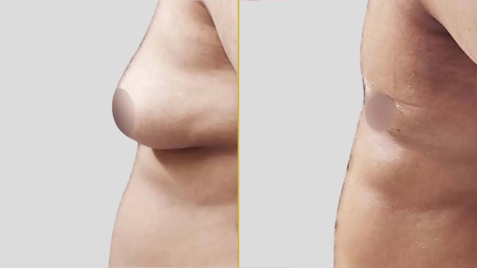 Gender Reassignment before and after result - The Hair and Shape Clinic, Mumbai