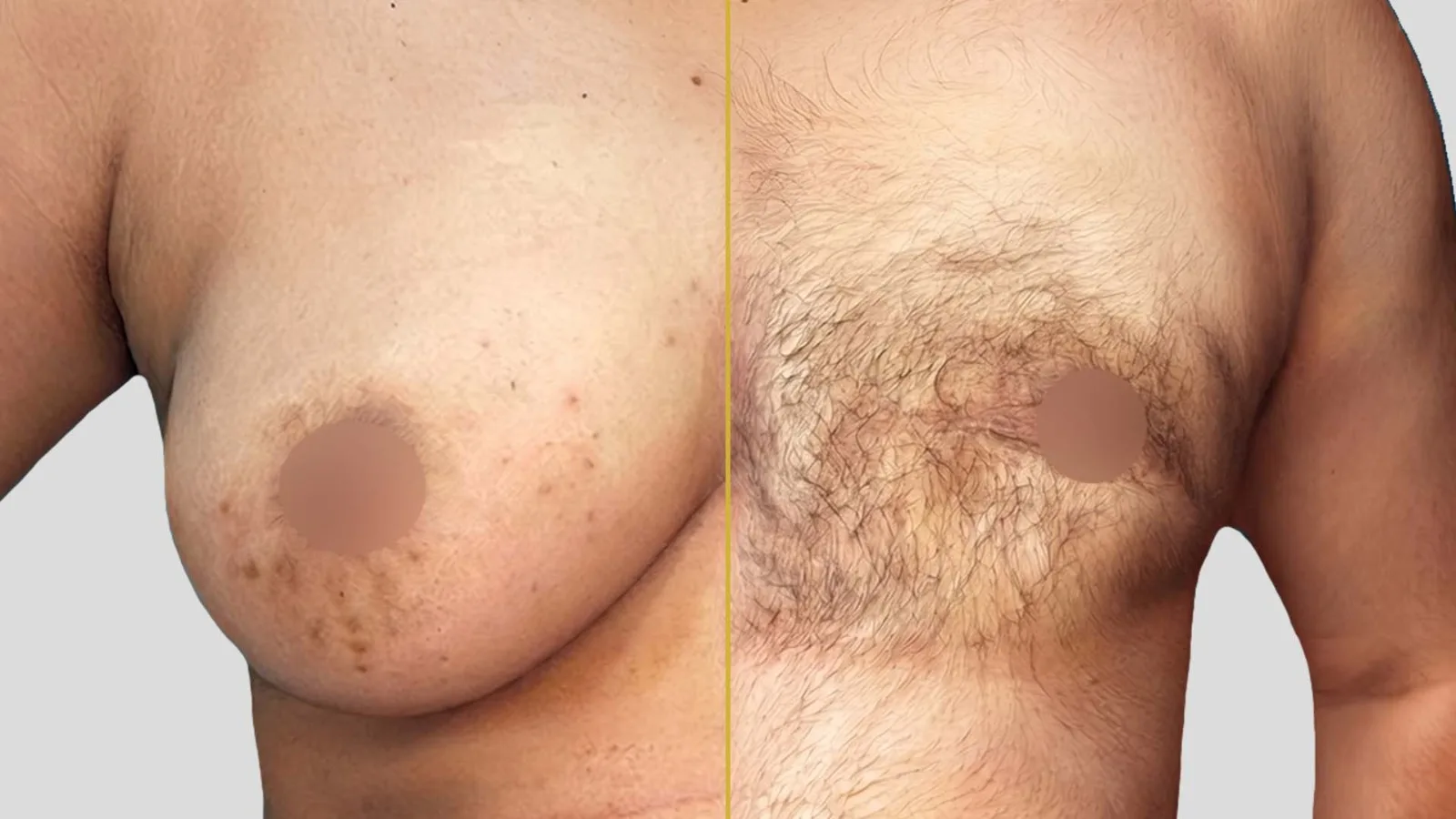 Gender Reassignment before and after result - The Hair and Shape Clinic, Mumbai