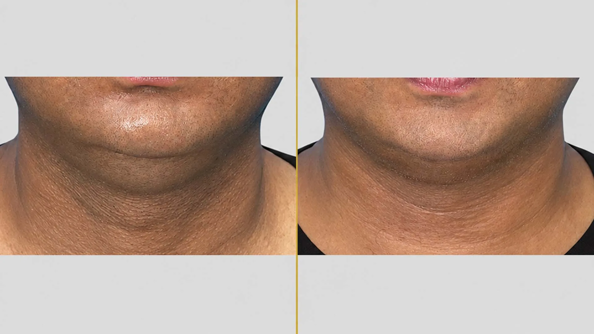 Genioplasty (Chin Surgery) before and after result - The Hair and Shape Clinic, Mumbai