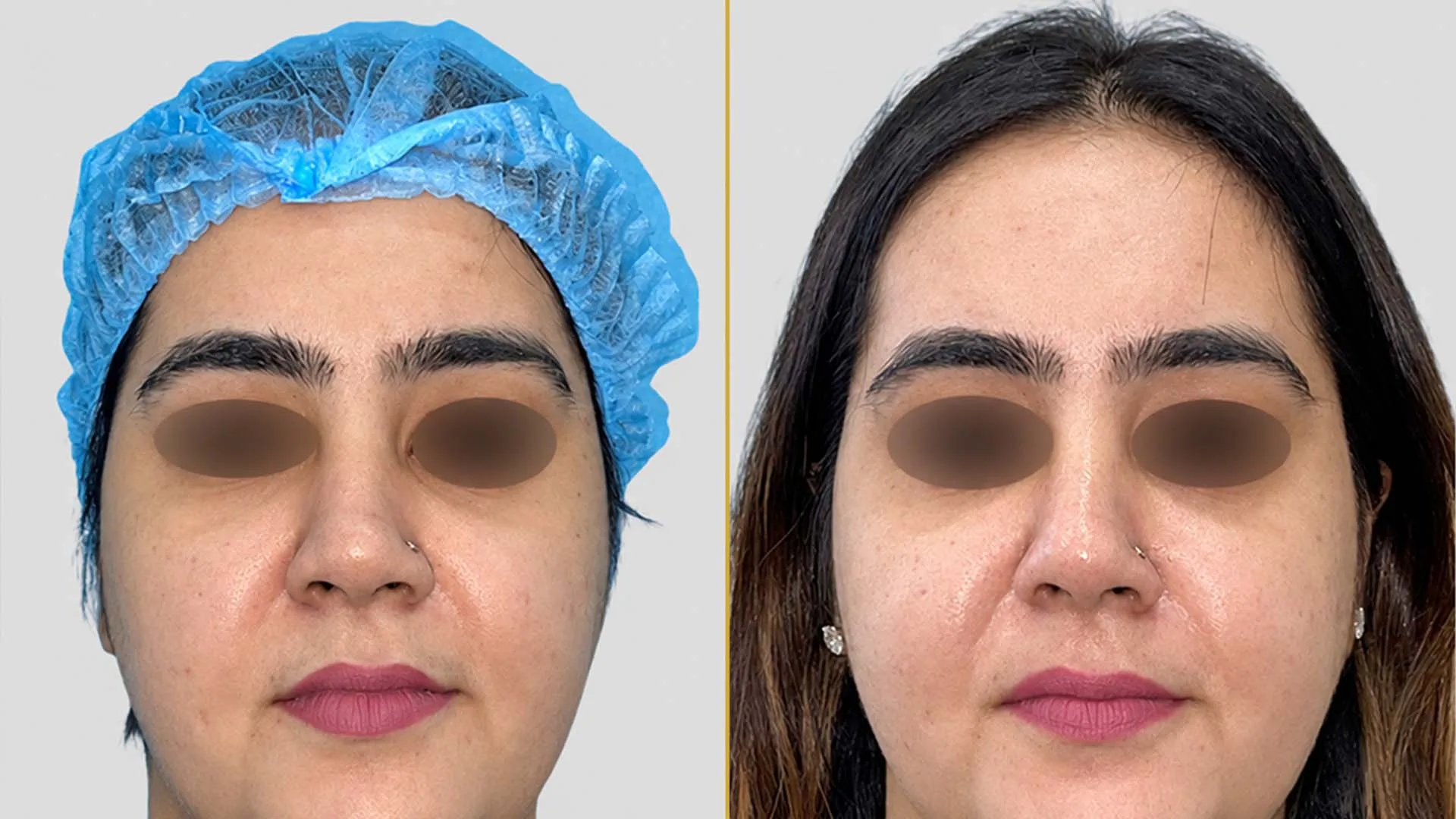 Genioplasty (Chin Surgery) before and after result - The Hair and Shape Clinic, Mumbai
