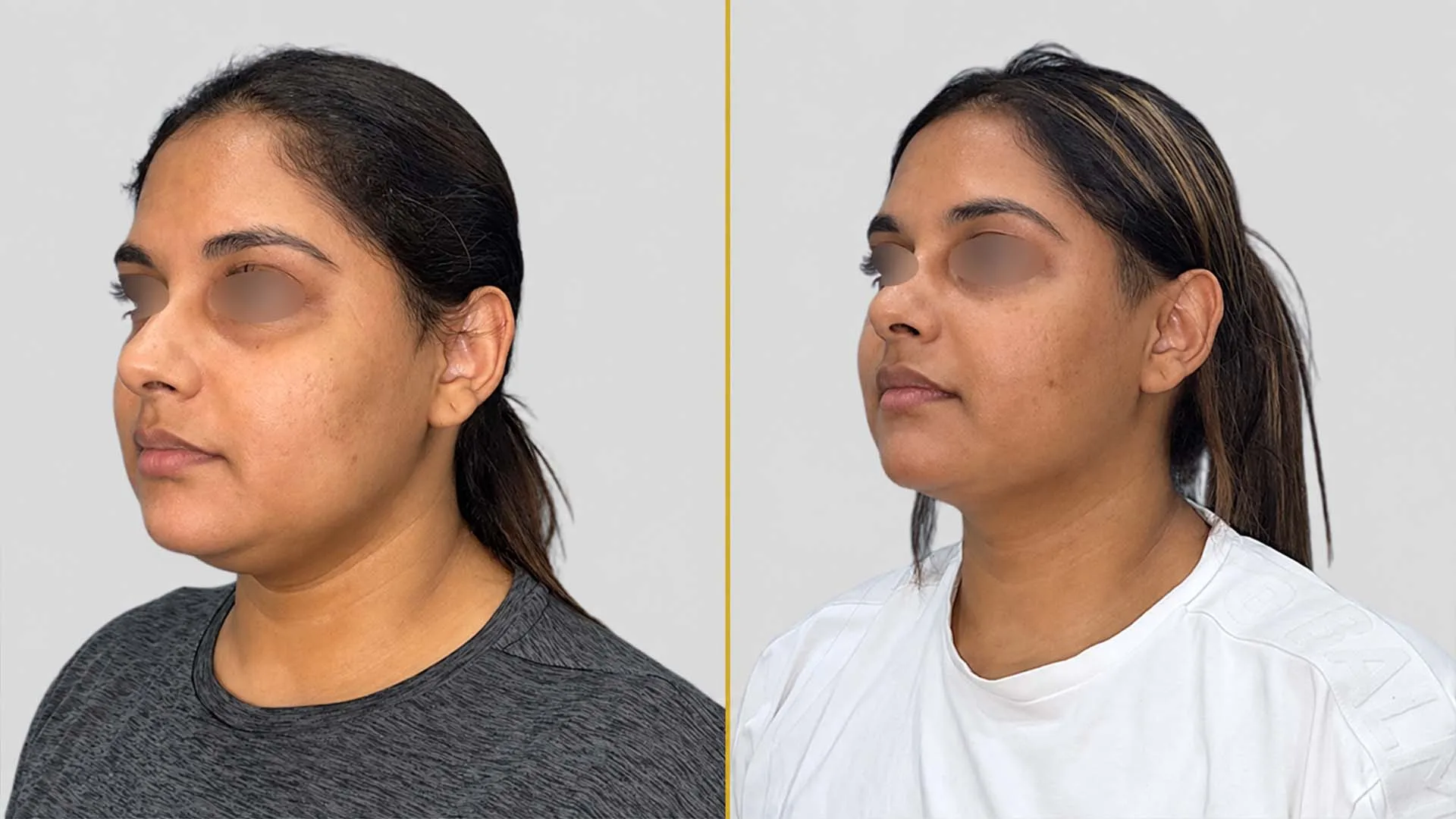 Genioplasty (Chin Surgery) before and after result - The Hair and Shape Clinic, Mumbai