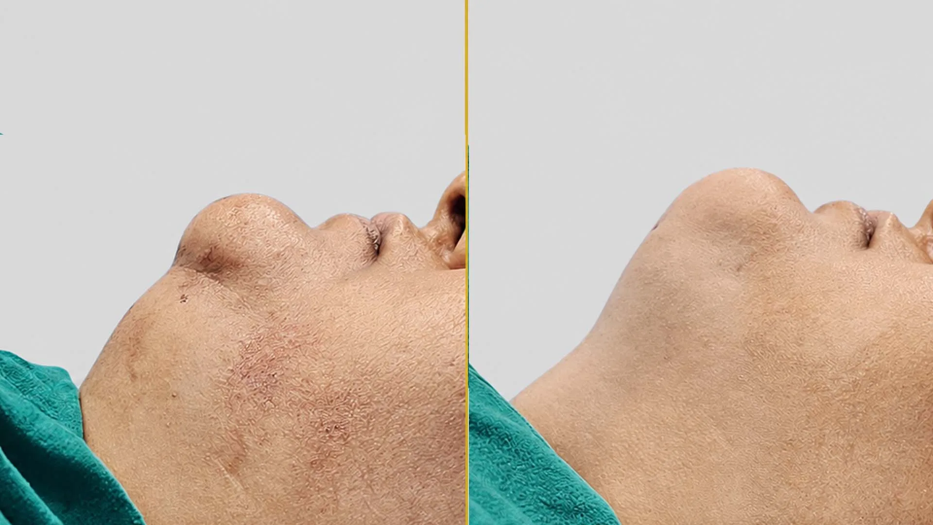 Genioplasty (Chin Surgery) before and after result - The Hair and Shape Clinic, Mumbai