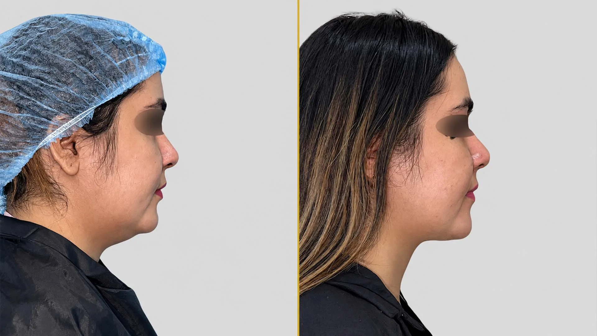 Genioplasty (Chin Surgery) before and after result - The Hair and Shape Clinic, Mumbai