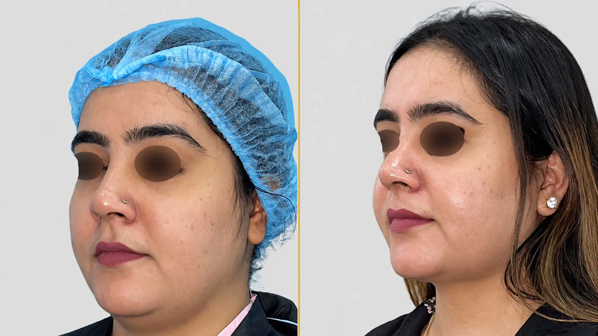 Genioplasty (Chin Surgery) before and after result - The Hair and Shape Clinic, Mumbai