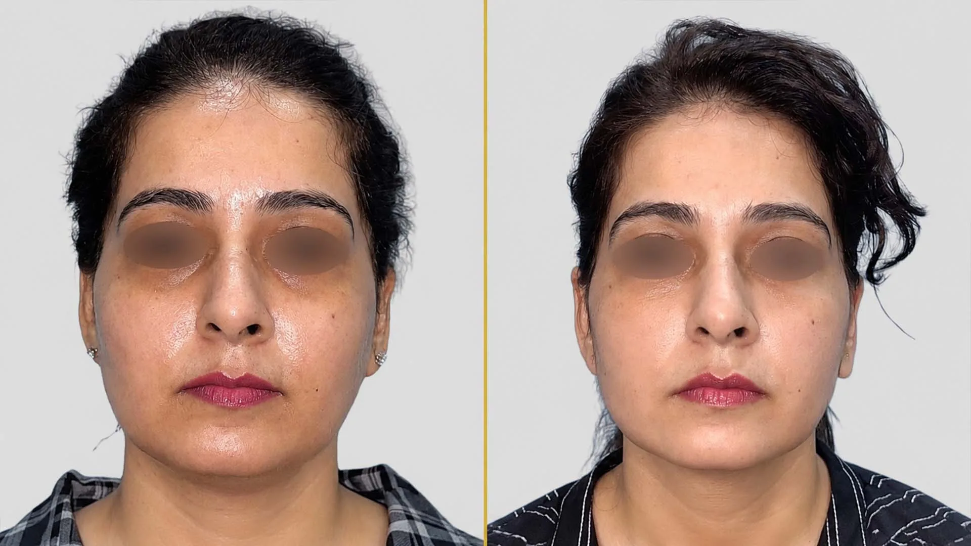 Genioplasty (Chin Surgery) before and after result - The Hair and Shape Clinic, Mumbai