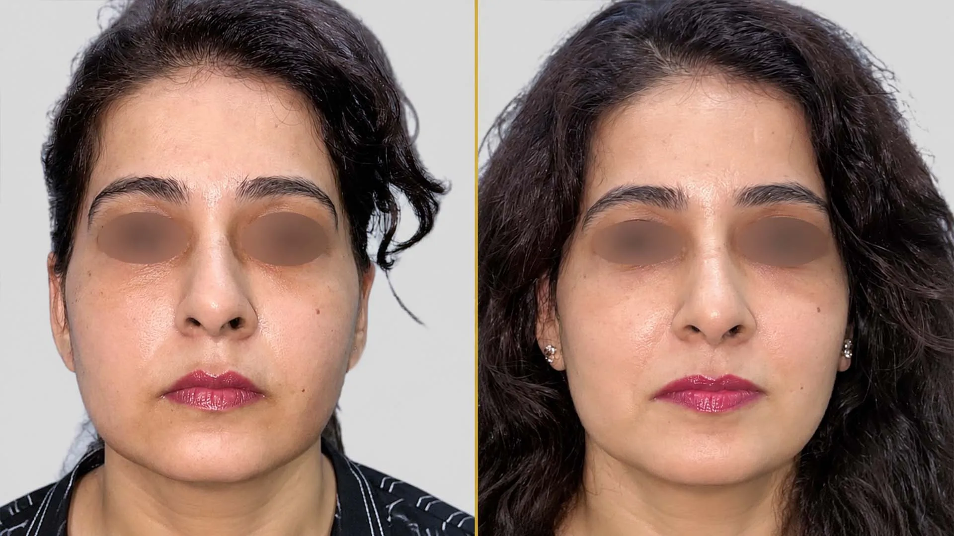 Genioplasty (Chin Surgery) before and after result - The Hair and Shape Clinic, Mumbai