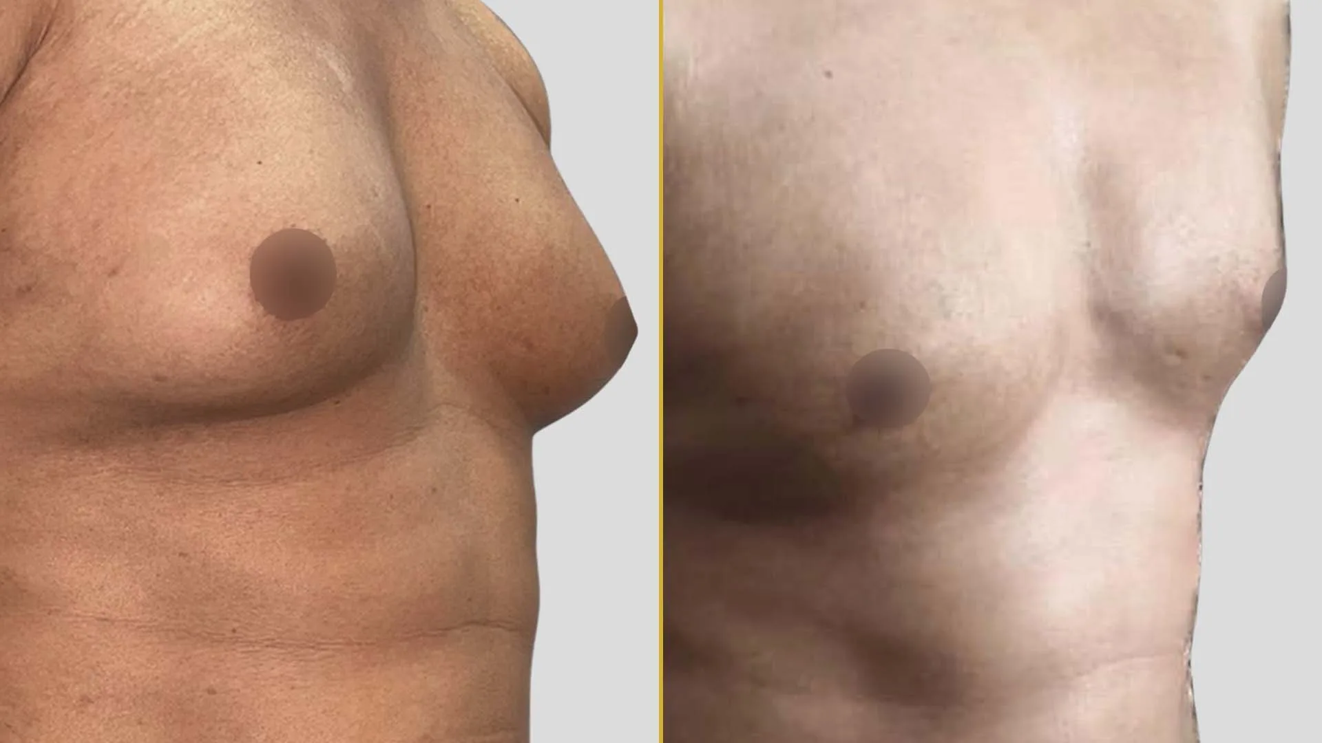 Gynecomastia Treatment before and after result - The Hair and Shape Clinic, Mumbai