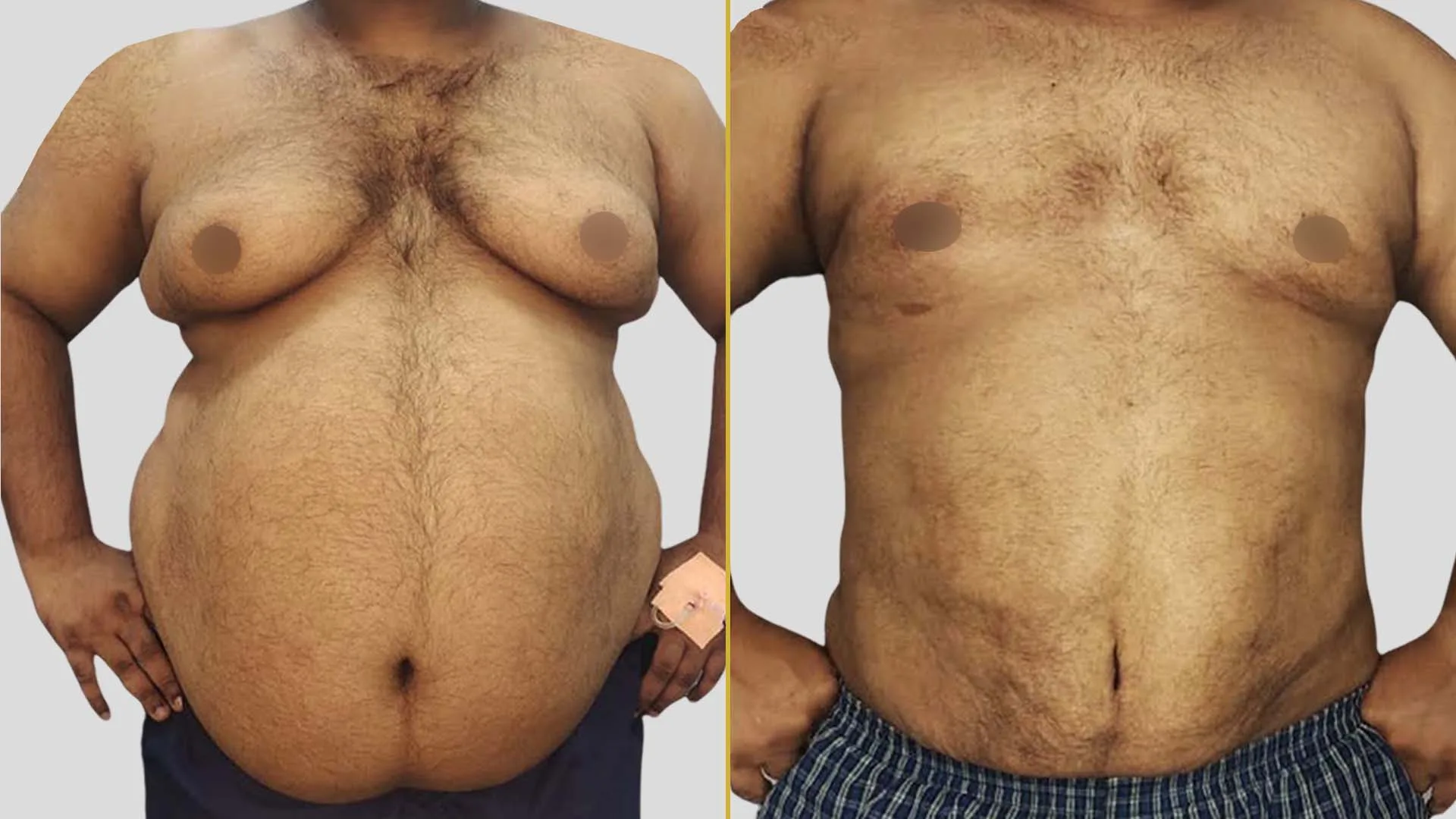 Gynecomastia Treatment before and after result - The Hair and Shape Clinic, Mumbai