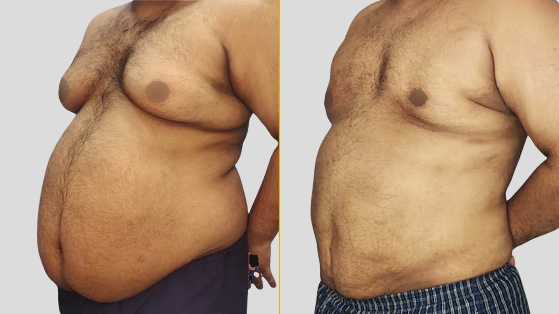Gynecomastia Treatment before and after result - The Hair and Shape Clinic, Mumbai