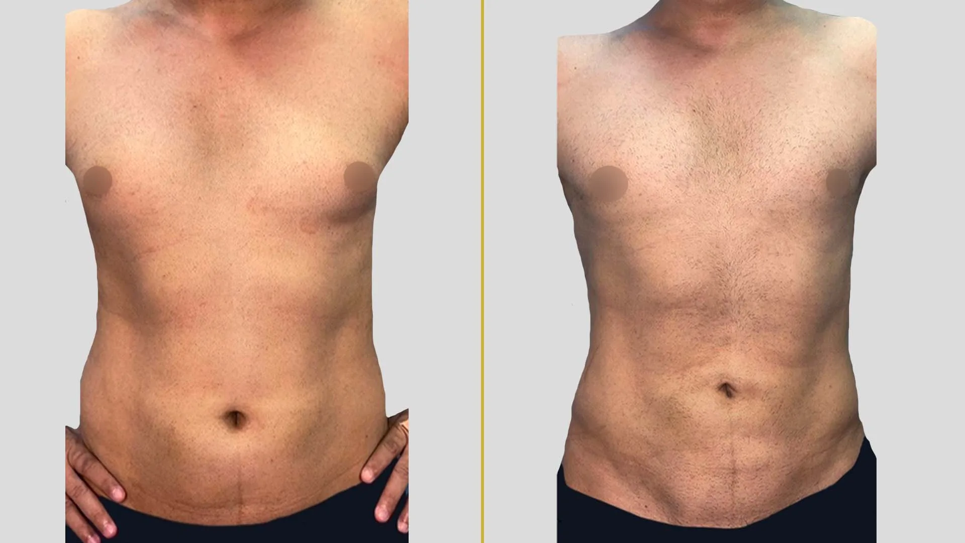 Gynecomastia Treatment before and after result - The Hair and Shape Clinic, Mumbai
