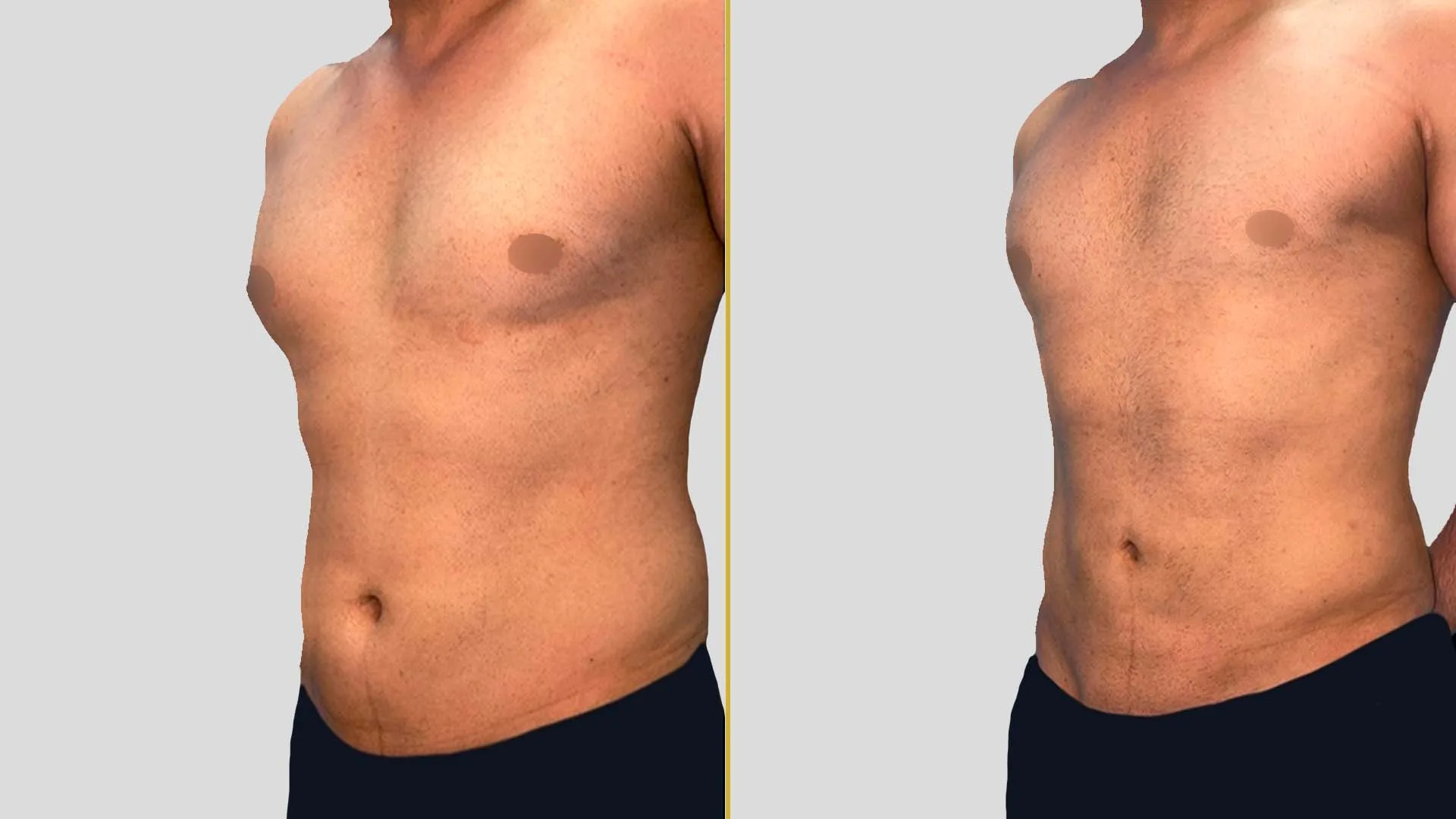 Gynecomastia Treatment before and after result - The Hair and Shape Clinic, Mumbai
