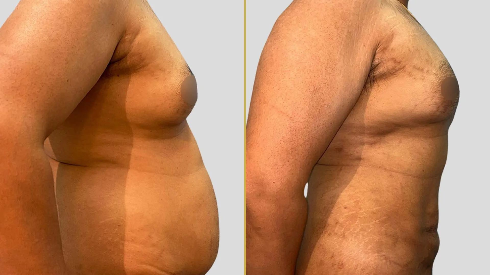 Gynecomastia Treatment before and after result - The Hair and Shape Clinic, Mumbai