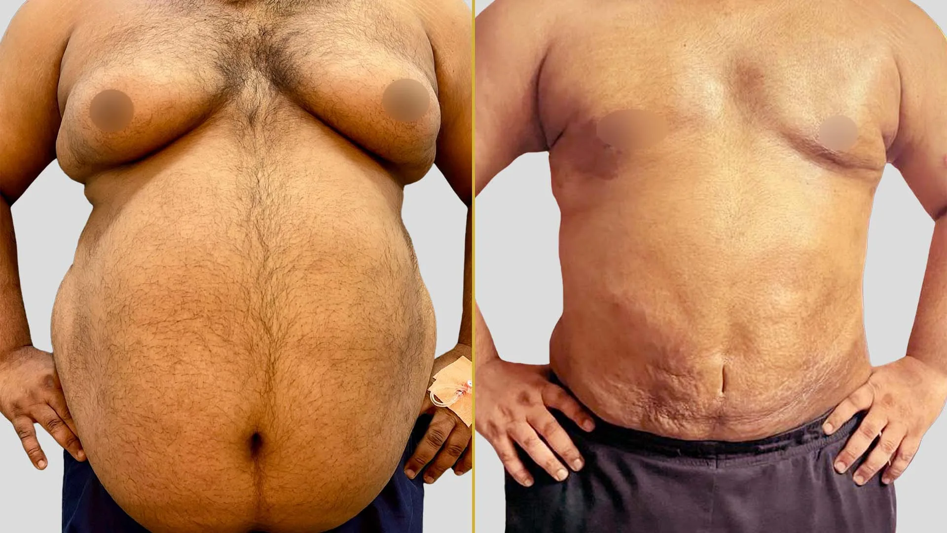 Gynecomastia Treatment before and after result - The Hair and Shape Clinic, Mumbai