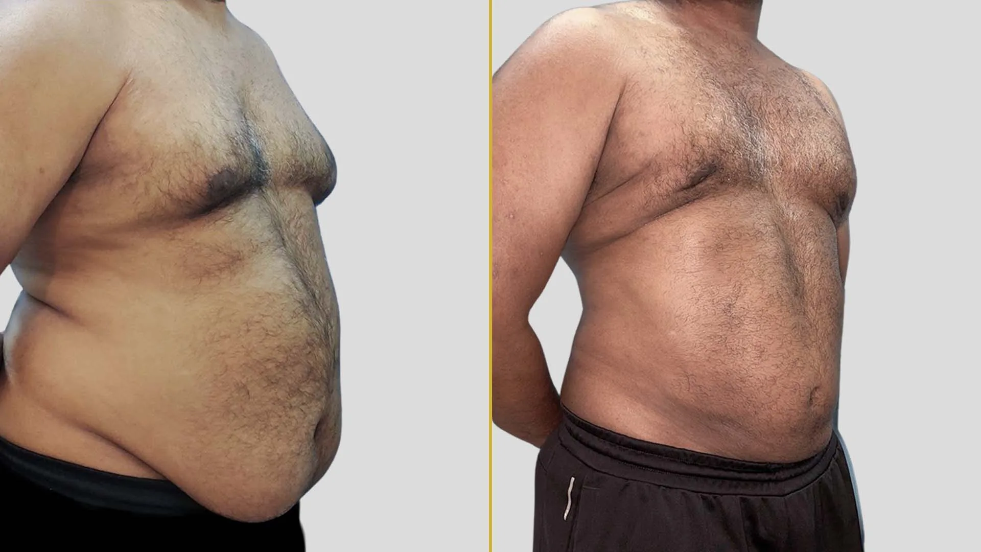 Gynecomastia Treatment before and after result - The Hair and Shape Clinic, Mumbai