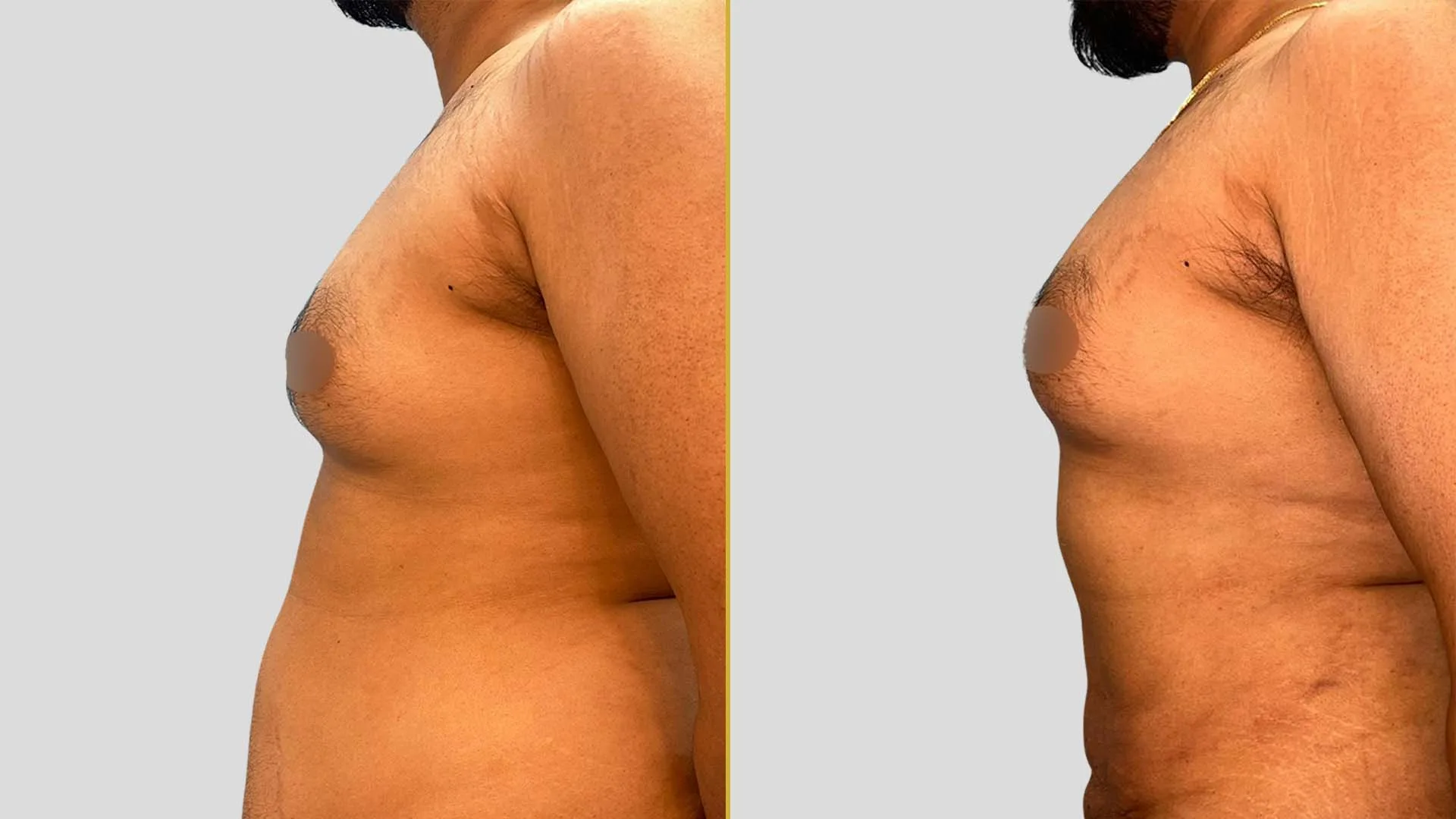 Gynecomastia Treatment before and after result - The Hair and Shape Clinic, Mumbai