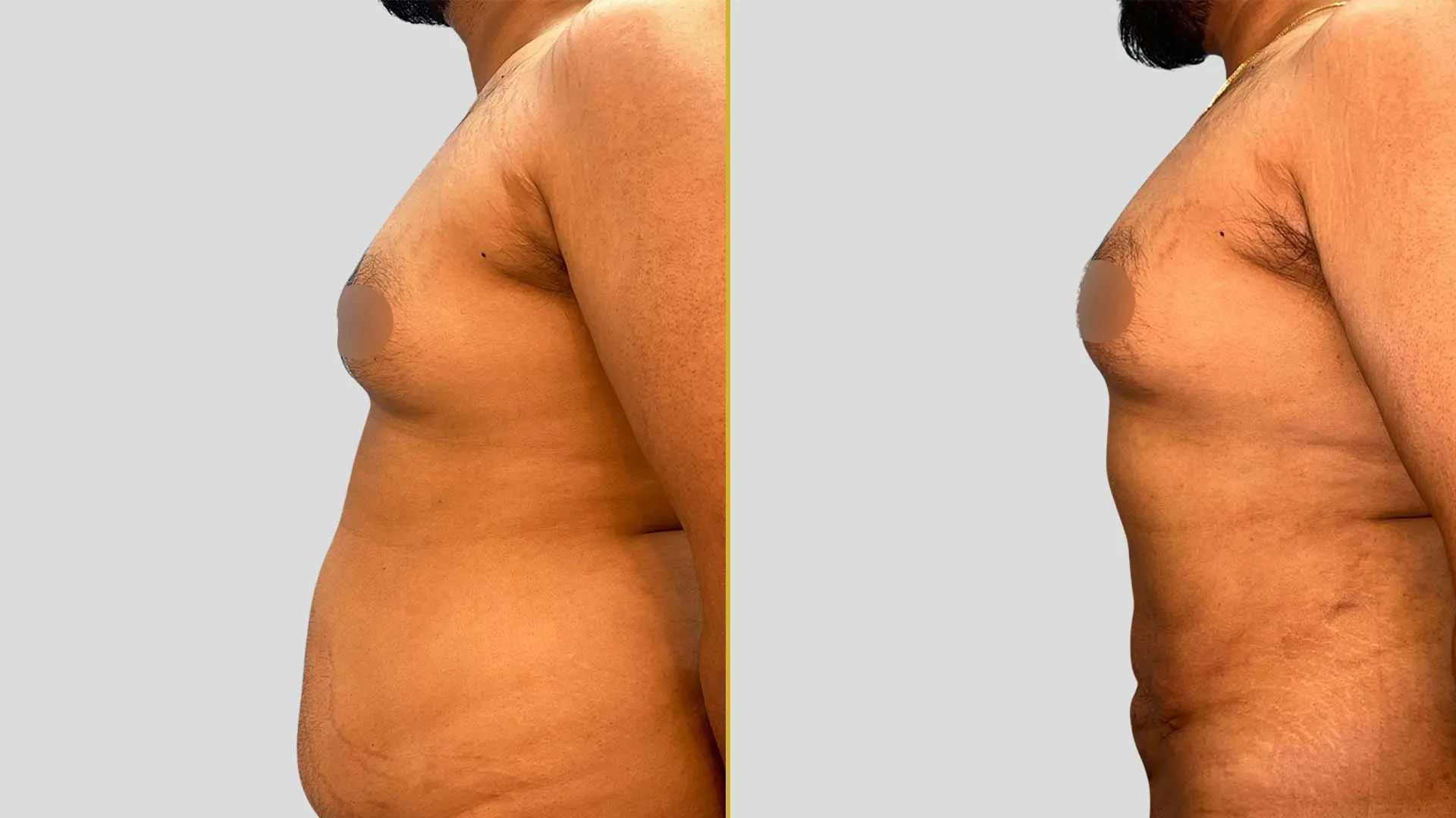 Gynecomastia Treatment before and after result - The Hair and Shape Clinic, Mumbai