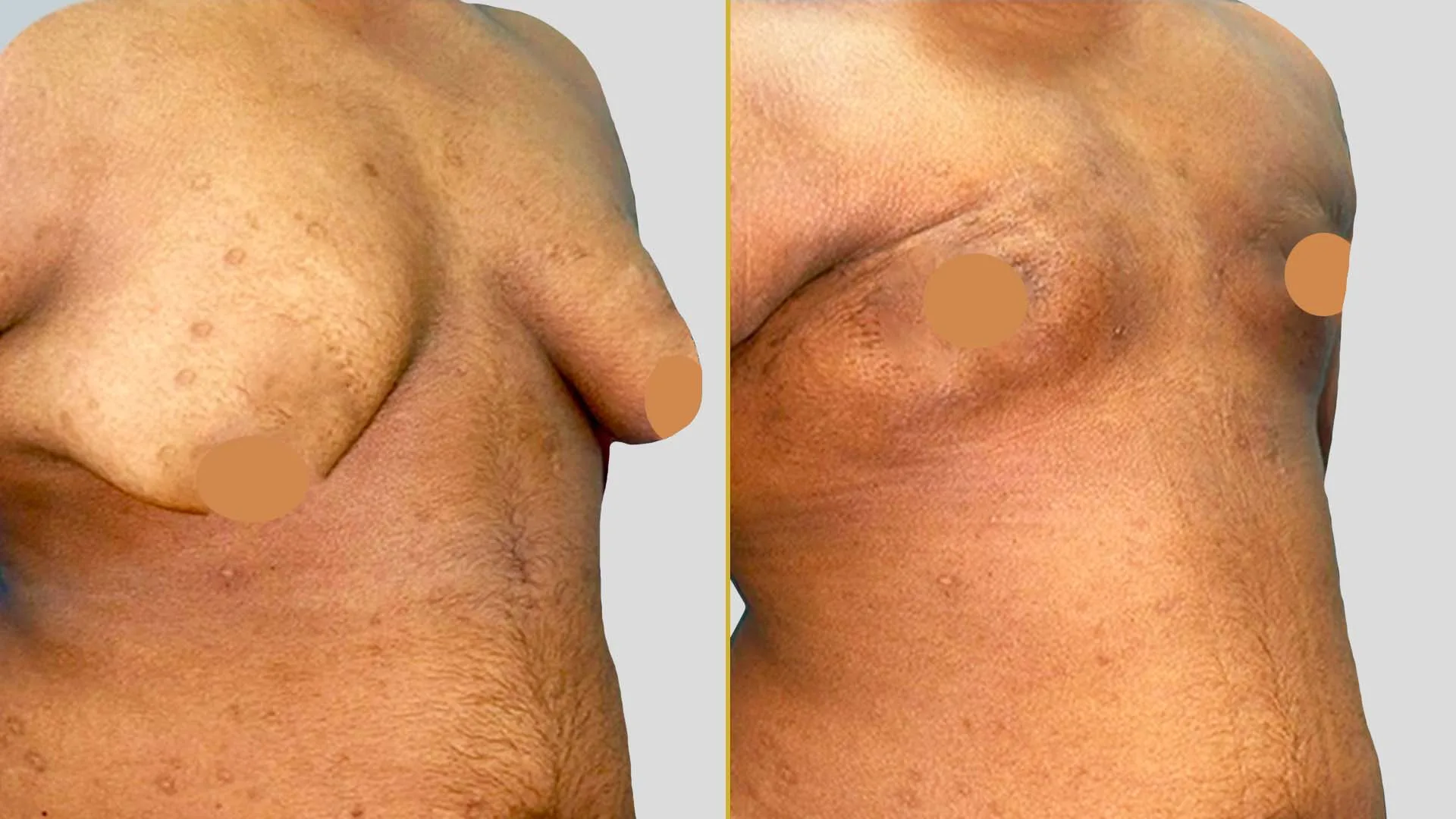 Gynecomastia Treatment before and after result - The Hair and Shape Clinic, Mumbai