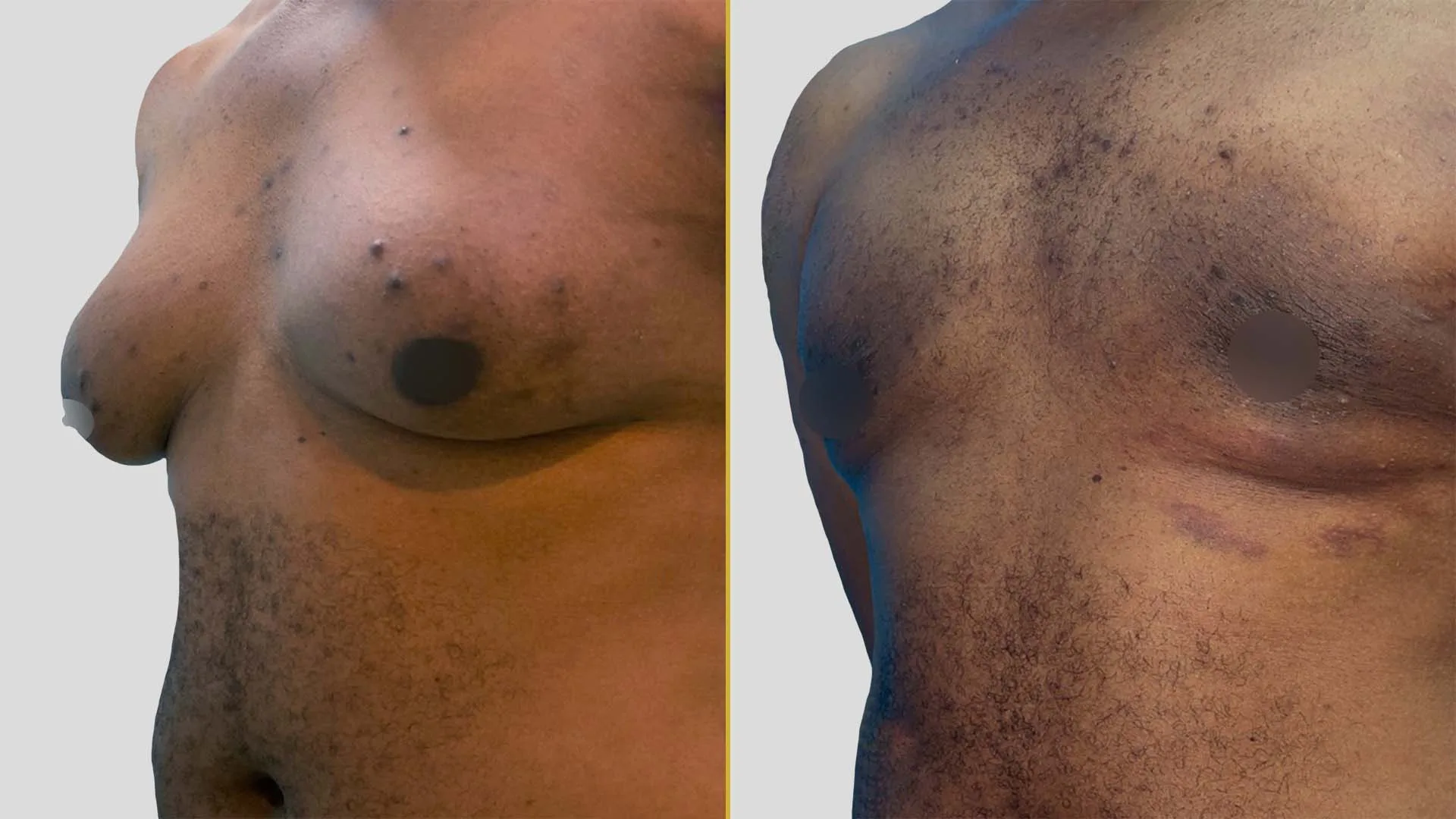 Gynecomastia Treatment before and after result - The Hair and Shape Clinic, Mumbai
