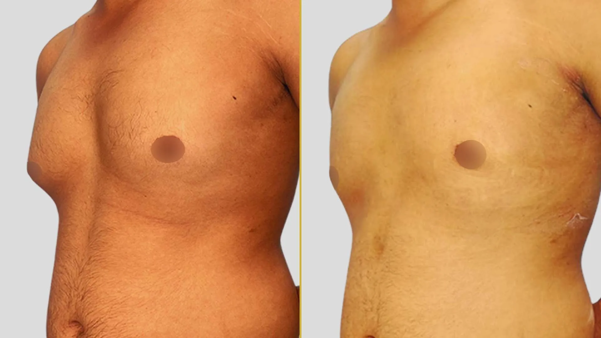 Gynecomastia Treatment before and after result - The Hair and Shape Clinic, Mumbai