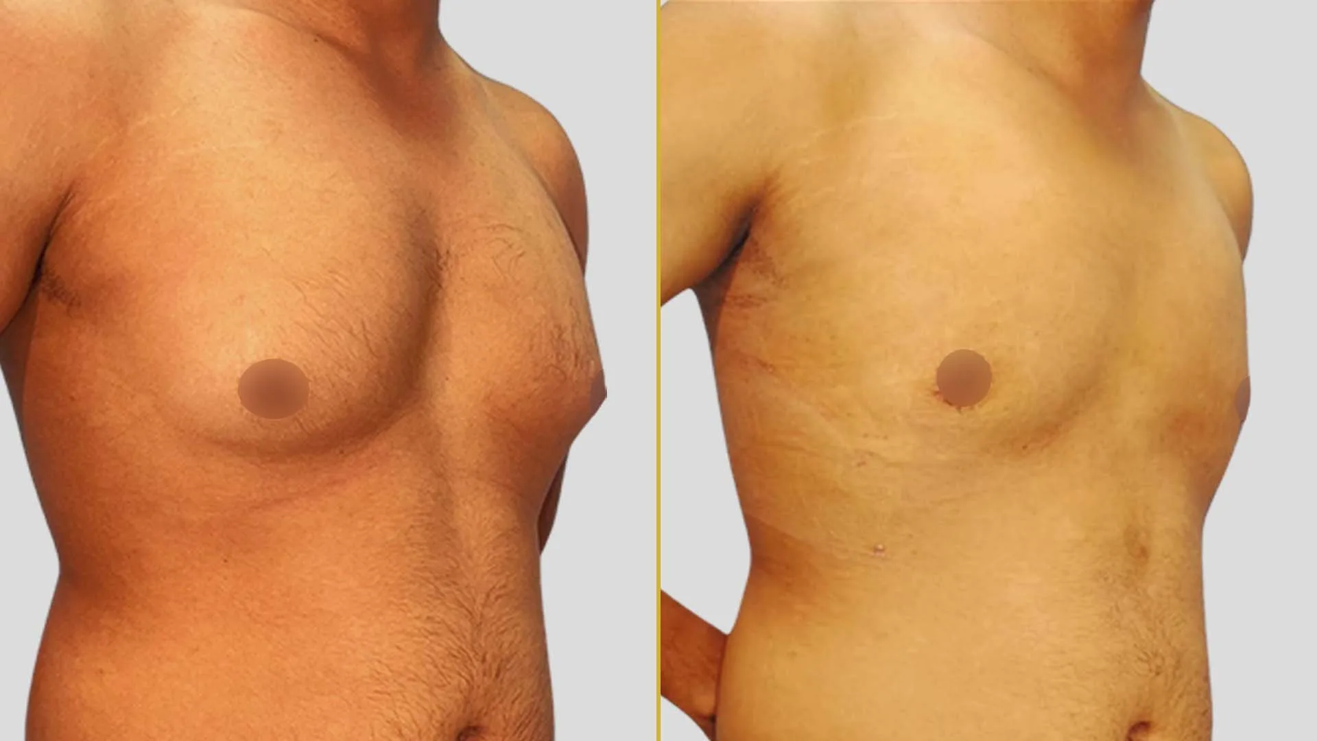 Gynecomastia Treatment before and after result - The Hair and Shape Clinic, Mumbai