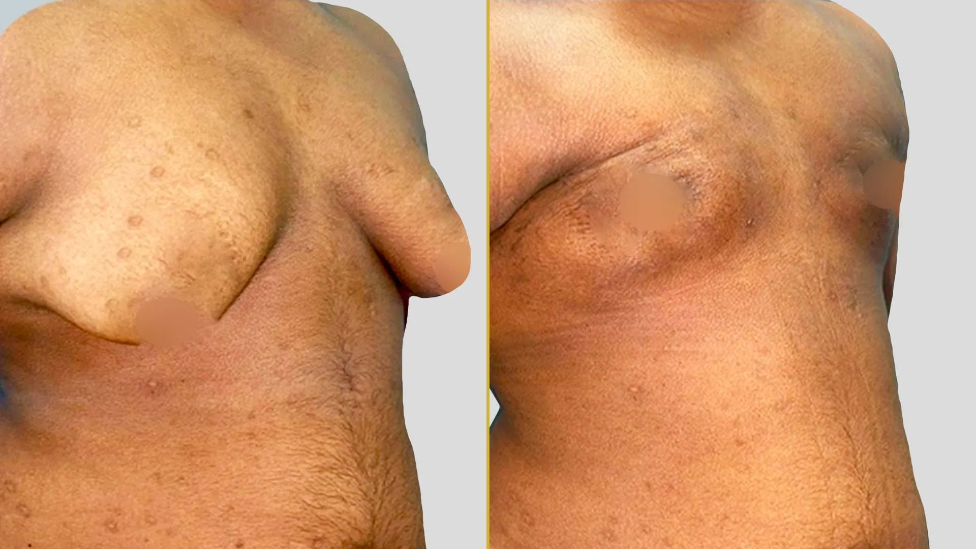 Gynecomastia Treatment before and after result - The Hair and Shape Clinic, Mumbai